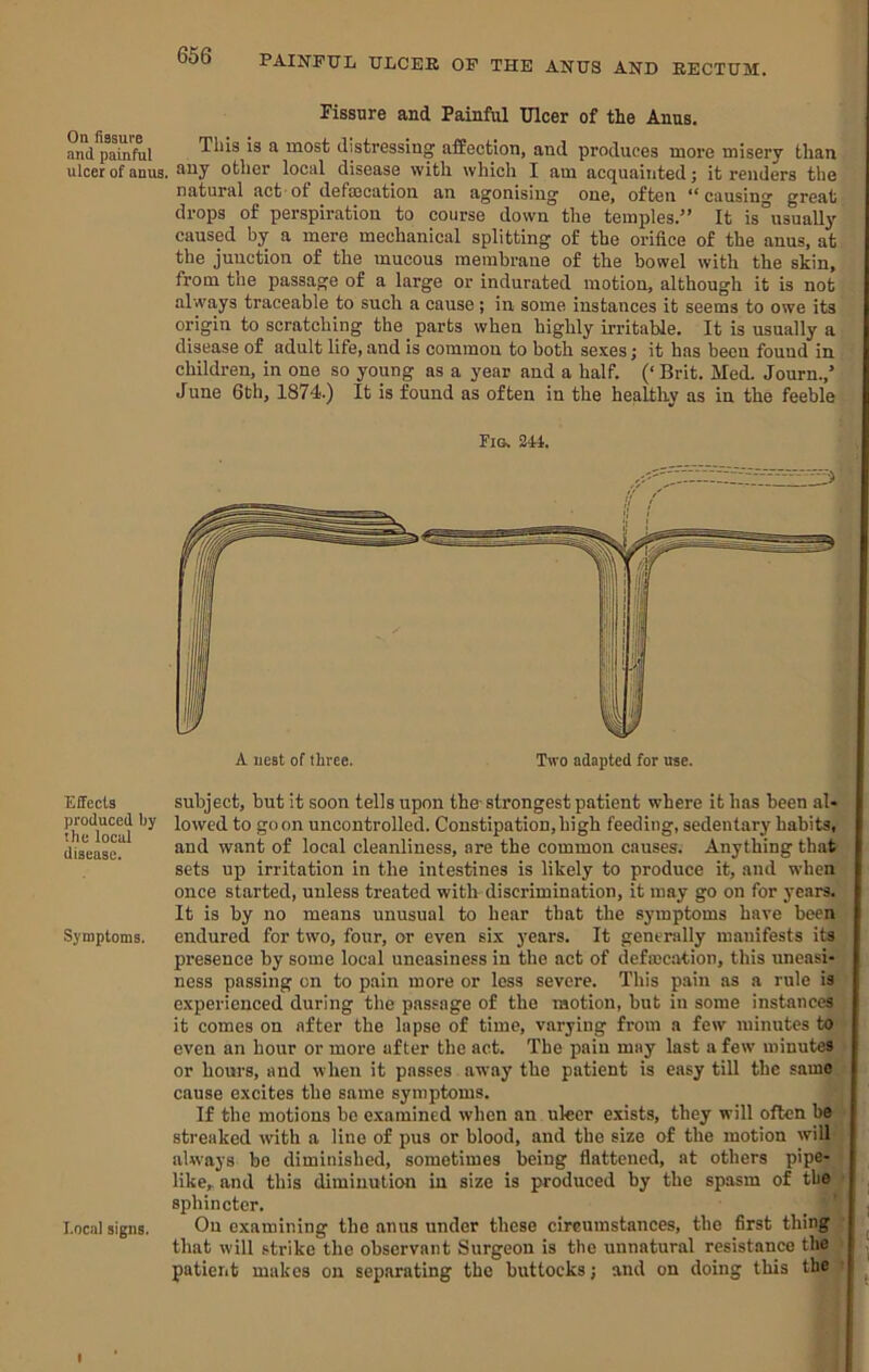 OP THE ANUS AND RECTUM. Fissure and Painful Ulcer of the Anus. and This is a most distressing affection, and produces more misery than ulcer of anus. other local disease with which I am acquainted; it renders the natural act'of defajcation an agonising one, often ** causing great drops of perspiration to course down the temples.” It is°usually caused by a mere mechanical splitting of the orifice of the anus, at the junction of the mucous membrane of the bowel with the skin, from the passage of a large or indurated motion, although it is not always traceable to such a cause ; in some instances it seems to owe its origin to scratching the parts when highly irritable. It is usually a disease of adult life, and is common to both sexes; it has been found in children, in one so young as a year and a half. (‘ Brit. Med. Journ.,’ June 6th, 1874.) It is found as often in the healthy as in the feeble Fig. 244. Effects produced by the local disease. Symptoms. Local signs. subject, but it soon tells upon the strongest patient where it has been al* lowed to goon uncontrolled. Constipation,high feeding, sedentary habits, and want of local cleanliness, are the common causes. Anything that sets up irritation in the intestines is likely to produce it, and when once started, unless treated with discrimination, it may go on for years. It is by no means unusual to hear that the symptoms have been endured for two, four, or even six years. It generally manifests its presence by some local uneasiness in the act of defmcation, this uneasi- ness passing on to pain more or loss severe. This pain as a rule is experienced during the passage of the motion, but in some instances it comes on after the lapse of time, varying from a few minutes to even an hour or more after the act. The pain may last a few minutes or hours, and when it passes away the patient is easy till the same cause excites the same symptoms. If the motions be examined when an ulcer exists, they will often be streaked with a line of pus or blood, and the size of the motion will always be diminished, sometimes being flattened, at others pipe- like, and this diminution in size is produced by the spasm of the , sphincter. . ' 1 On examining the anus under these circumstances, the first thing ^ that will strike the observant Surgeon is the unnatural resistance the ^ patient makes on separating the buttocks; and on doing this the ^ I