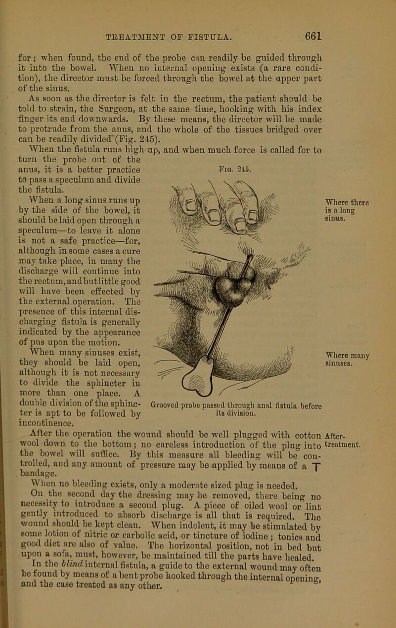 Fro. 245. for; when found, the end of the probe cnn readily be guided through it into the bowel. When no internal opening exists (a rare condi- tion), the director must be forced through the bowel at the upper part of the sinus. As soon as the director is felt in the rectum, the patient should be told to strain, the Surgeon, at the same time, hooking with his index finger its end downwards. By these means, the director will be made to protrude from the anus, and the whole of the tissues bridged over can be readily divided'(Fig. 245). When the fistula runs high up, and when much force is called for to turn the probe out of the anus, it is a better practice to pass a speculum and divide the fistula. When a long sinus runs up by the side of the bowel, it should be laid open through a speculum—to leave it alone is not a safe practice—^for, although in some cases a cure may take place, in many the discharge will continue into the rectum, audbutlittle good wdll have been effected by the external operation. The presence of this internal dis- charging fistula is generally indicated by the appearance of pus upon the motion. When many sinuses exist, they should be laid open, although it is not necessary to divide the sphincter in more than one place. A double division of the sphinc- ter is apt to be followed by incontinence. Grooved probe passed through anal fistula before its division. Where there is a long sinus. Where many sinuses. After the operation the wound should be well plugged with cotton After- W'ool down to the bottom j no careless introduction of the plug into treatment, the bowel will suffice. By this measure all bleeding will be con- trolled, and any amount of pressure may be applied by means of a T bandage. When no bleeding exists, only a moderate sized plug is needed. On the sewnd day the dressing may be removed, there being no necessity to introduce a second plug. A piece of oiled wool or lint gently introduced to absorb discharge is all that is required. The wound should be kept clean. When indolent, it may be stimulated by some lotion of nitric or carbolic acid, or tincture of iodine; tonics and good diet are also of value. The horizontal position, not in bed but upon a sofa, must, however, be maintained till the parts have healed. In the 5iiacZ internal fistula, a guide to the external wound may often be found by means of a bent probe hooked through the internal oneninsr and the case treated as any other- ^