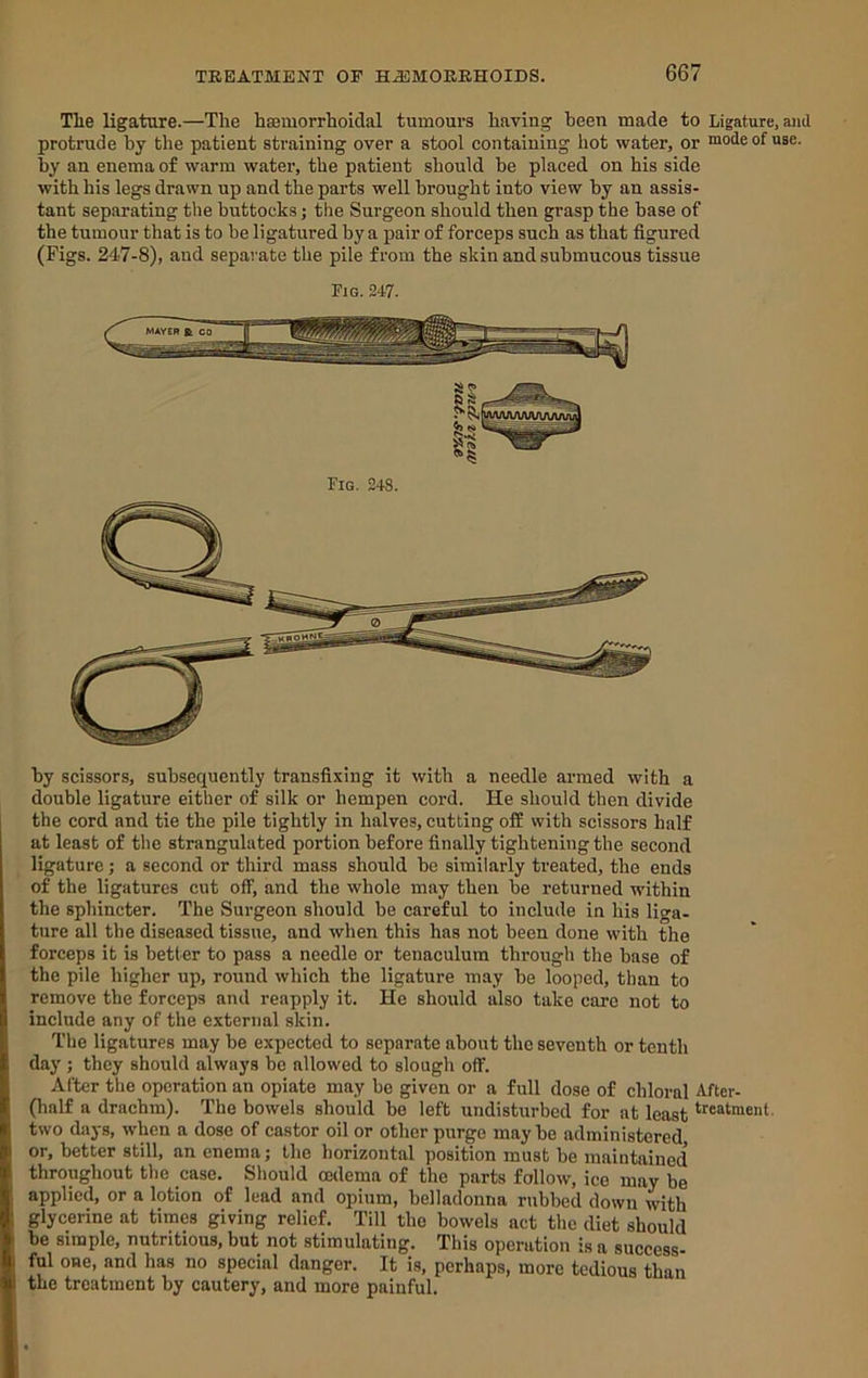 Tlie ligature.—The haemorrhoidal tumours having been made to Ligature, and protrude by the patient straining over a stool containing hot water, or mode of use. by an enema of warm water, the patient should be placed on his side with his legs drawn up and the parts well brought into view by an assis- tant separating the buttocks; the Surgeon should then grasp the base of the tumour that is to be ligatured by a pair of forceps such as that figured (Figs. 247-8), and separate the pile from the skin and snbmncous tissue Fig. 247. by scissors, subsequently transfixing it with a needle armed with a double ligature either of silk or hempen cord. He should then divide the cord and tie the pile tightly in halves, cutting ofE with scissors half at least of the strangulated portion before finally tightening the second ligature; a second or third mass should be similarly treated, the ends of the ligatures cut off, and the whole may then be returned within the sphincter. The Surgeon should be careful to include in his liga- ture all the diseased tissue, and when this has not been done with the forceps it is better to pass a needle or tenaculum through the base of the pile higher up, round which the ligature may be looped, than to remove the forceps and reapply it. He should also take care not to include any of the external skin. The ligatures may be expected to separate about the seventh or tenth day ; they should always be allowed to slough off. After the operation an opiate may be given or a full dose of chloral After- (balf a drachm). The bowels should be left undisturbed for at least treatment, two days, when a dose of castor oil or other purge may be administered or, better still, an enema; the horizontal position must be maintained throughout the case. Should cedema of the parts follow, ice may be applied, or a lotion of lead and opium, belladonna rubbed down with glycerine at times giving relief. Till the bowels act the diet should be simple, nutritious, but not stimulating. This operation is a success- ful one, and has no special danger. It is, perhaps, more tedious than the treatment by cautery, and more painful.