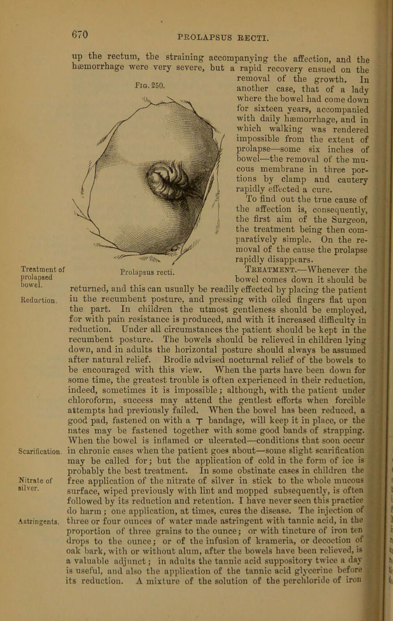 lip the rectum, the straining accompanying the affection, and the hiemorrhage were very severe, but a rapid recovery ensued on the removal of the growth. In another case, that of a lady where the bowel had come down for sixteen years, accompanied with daily haemorrhage, and in which walking was rendered impossible from the extent of prolapse—some six inches of bowel—the removal of the mu- cous membrane in three por- tions by clamp and cautery rapidly effected a cure. To find out the true cause of the affection is, consequently', the first aim of the Surgeon, the treatment being then com- paratively simple. On the re- moval of the cause the prolapse rapidly disappears. Treatment.—Whenever the bowel comes down it should be returned, and this can usually be readily effected by placing the patient Reduftion. iu the recumbent posture, and pressing with oiled fingers fiat upon the part. In children the utmost gentleness should be employed, for with pain resistance is produced, and mth it increased difficulty in reduction. Under all circumstances the patient should be kept in the recumbent posture. The bowels should be relieved in children lying down, and in adults the horizontal posture should always be assumed after natural relief. Brodie advised nocturnal relief of the bowels to be encouraged with this view. When the parts have been down for some time, the greatest trouble is often experienced in their reduction, indeed, sometimes it is impossible; although, with the patient under chloroform, success may attend the gentlest efforts when forcible attempts had previously failed. When the bowel has been reduced, a good pad, fastened on with a y bandage, will keep it in place, or the nates may be fastened together with some good bands of strapping. When the bowel is inflamed or ulcerated—conditions that soon occur Scarification, in chronic cases when the patient goes about—some slight scarification may be called for; but the application of cold in the form of ice is probably the best treatment. In some obstinate cases in children the Nitrate of free application of the nitrate of silver in stick to the whole mucous silver. surface, wiped previously with lint and mopped subsequently, is often followed by its reduction and retention. I have never seen this practice do harm ; one application, at times, cures the disease. The injection of ■Astringents, three or four ounces of water made astringent with tannic acid, in the proportion of three grains to the ounce; or with tincture of iron ten drops to the ounce; or of the infusion of krameria, or decoction of oak bark, with or without alum, after the bowels have been relieved, is a valuable adjunct; in adults the tannic acid suppository twice a day is useful, and also the application of the tannic acid glycerine before its reduction. A mixture of the solution of the perchloride of iron Treatment of prolapsed Prolapsus recti.