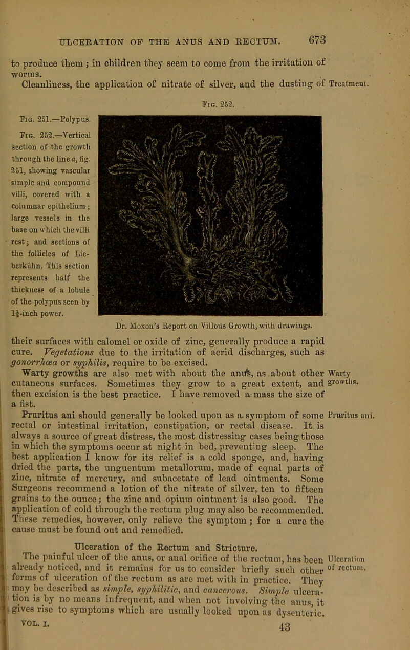 to produce them ; in children they seem to come from the irritation of worms. Cleanliness, the application of nitrate of silver, and the dusting of Treatment. Ftr. 252. Fig. 251.—Polypus. Fig. 252.—Vertical section of the growth through the line a, fig. 251, showing vascular simple and compound villi, covered with a columnar epithelium large vessels in the base on which the villi restj and sections of the follicles of Lie- berkuhn. This section represents half the thickness of a lobule of the polypus seen by 14-iuch power. Dr. Mo.xon’s Report on Villous Growth, with drawings. their surfaces with calomel or oxide of zinc, generally produce a rapid cure. Vegetations due to the irritation of acrid discharges, such as gonorrhoea or syphilis, require to be excised. Warty growths are also met with about the anufe, as .about other Warty cutaneous surfaces. Sometimes they grow to a great extent, and growths, then excision is the best practice. I have removed a- mass the size of a fist. Pruritus ani should generally he looked upon as a, symptom of some Pruritus ani. rectal or intestinal irritation, constipation, or rectal disease. It is always a source of great distress, the most distressing cases being those in which the symptoms occur at night in bed, preventing sleep. The r be.st application I know for its relief is a cold sponge, and, having dried the parts, the unguentum metallorum, made of equal parts of |l zinc, nitrate of mercury, and subacetate of lead ointments. Some |; Surgeons recommend a lotion of the nitrate of silver, ten to fifteen * grains to the ounce; the zinc and opium ointment is also good. The i application of cold through the rectum plug may also be recommended. ; Tliese remedies, however, only relieve the symptom; for a cure the cause must be found out and remedied. Ulceration of the Bectum and Stricture. The painful ulcer of the anus, or anal orifice of tlie rectum, has been Ulceration already noticed, jind it remains for us to consider briefly such other «ctum. i forms of ulceration of the rectum as are met with in practice. They may be described as simple, syphilitic, and cancerous. Simple ulcera- itionisby no means infrequent, and when not involving the anus, it ; gives rise to symptoms which are usually looked upon as dysenteric, vox. I.