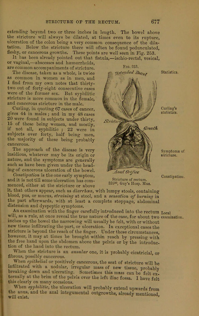 extending beyond two or three inches in length. The howel above the stricture will always be dilated, at times even to its rupture, ulceration of the colon being a very common consequence of the dila- tation. Below the stricture there will often he found pedunculated, fleshy, or cancerous growths. These points are well seen in Fig. 253. It has been already pointed out that fistula,—ischio-rectal, vesical, or vaginal,—abscesses and hsemorrhoids, are common accompaniments of stricture. The disease, taken as a whole, is twice as common in women as in men, and I find from my own notes that thirty- two out of forty-eight consecutive cases were of the former sex. But syphilitic stricture is more common in the female, and cancerous stricture in the male. ^ Curling, in quoting 67 cases of cancer, gives 44 in males; and in my 48 cases 20 were found in subjects under thirty, 15 of these being women, and mostly, if not all, syphilitic ; 22 were in subjects over forty, half being men, the majority of these being probably cancerous. The approach of the disease is very insidious, whatever may be its origin or nature, and the symptoms are generally such as have been given under the head- ing of cancerous ulceration of the bowel. Constipation is the one early symptom, and it is not till some ulceration has com- menced, either at the stricture or above it, that others appear, such as diarrhoea, with lumpy stools, containing blood, pus, or mucus, straining at stool, and a sensation of burning in the part afterwards, with at least a complete stoppage, abdominal distension and dyspeptic symptoms. An examination with the finger carefully introduced into the rectum will, as a rule, at once reveal the true nature of the case, for about two inches up the bowel the narrowing will usually be felt, with or without new tissue infiltrating the part, or ulceration. In exceptional cases the stricture is beyond the reach of the finger. Under these circumstances, however, it may at times be brought within reach by pressing with the free hand upon the abdomen above the pelvis or by the introduc- tion of the hand into the rectum. When the stricture is an annular one, it is probably cicatricial, or fibrous, possibly cancerous. When epithelial or positively cancerous, the seat of stricture will bo infiltrated with a nodular, irregular mass of new tissue, probably breaking down and ulcerating. Sometimes this mass can be felt ex- ternally at the brim of the pelvis over the left iliac fossa. I have felt this clearly on many occasions. Wlien syphilitic, the ulceration will probably extend upwards from the anus, and the anal integumental outgrowths, already mentioned will exist. ' Fig. 253. Jlncfl Onyire Stricture of rectum. 32550, Guy’s Hosp. Mua. Statistics. Curling’s statistics. Symptoms of stricture. Constipation. Local examination.