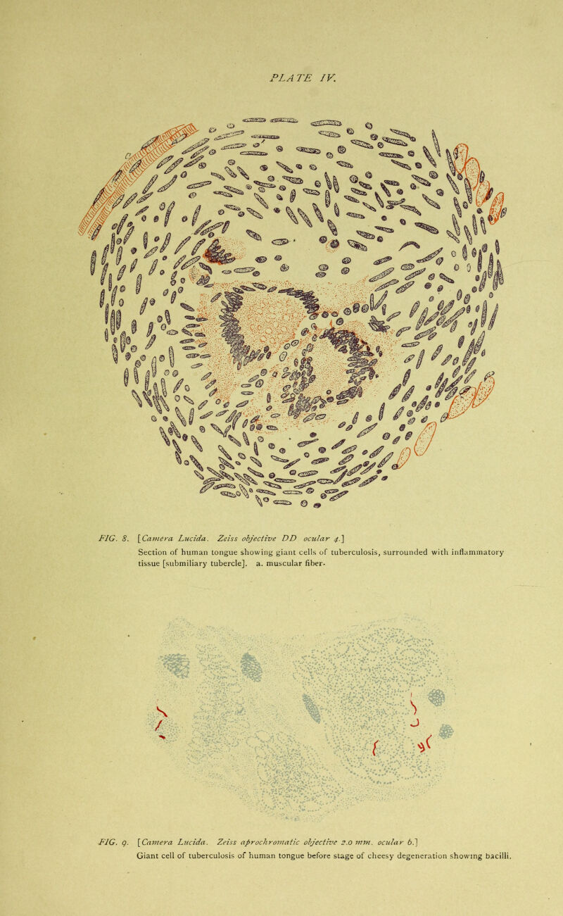 FIG. 8. [Camera Lucida. Zeiss objective DD ocular 4.] Section of human tongue showing giant cells of tuberculosis, surrounded with inflammatory- tissue [submiliary tubercle], a. muscular fiber- FIG. 9. [Camera Lucida. Zeiss aprochromatic objective 2.0 mm. ocular 6.] Giant cell of tuberculosis of human tongue before stage of cheesy degeneration showing bacilli.