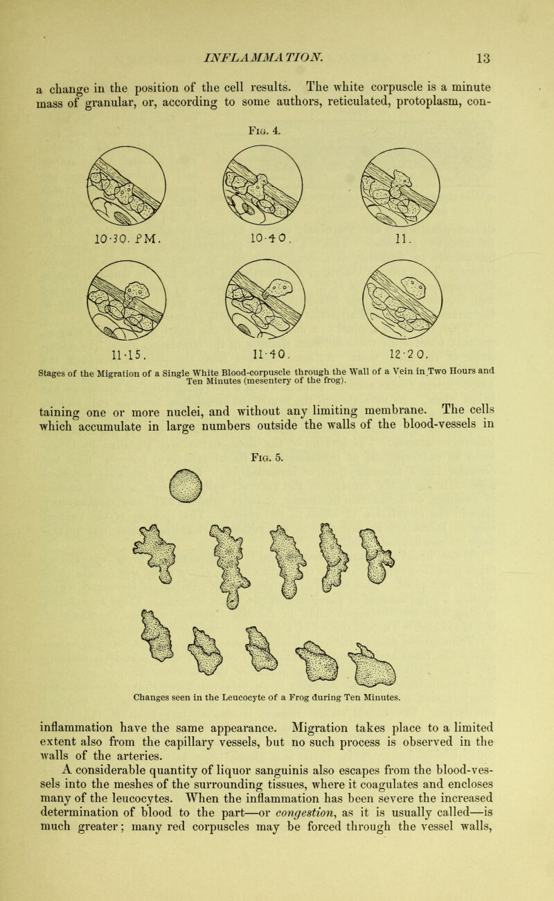 a change in the position of the cell results. The white corpuscle is a minute mass of granular, or, according to some authors, reticulated, protoplasm, con- Fig. 4. 11-15. 11-40. 12-20. Stages of the Migration of a Single White Blood-corpuscle through the Wall of a Vein in Two Hours and Ten Minutes (mesentery of the frog). taining one or more nuclei, and without any limiting membrane. The cells which accumulate in large numbers outside the walls of the blood-vessels in Fig. 5. Changes seen in the Leucocyte of a Frog during Ten Minutes. inflammation have the same appearance. Migration takes place to a limited extent also from the capillary vessels, but no such process is observed in the walls of the arteries. A considerable quantity of liquor sanguinis also escapes from the blood-ves- sels into the meshes of the surrounding tissues, where it coagulates and encloses many of the leucocytes. When the inflammation has been severe the increased determination of blood to the part—or congestion, as it is usually called—is much greater; many red corpuscles may be forced through the vessel walls,
