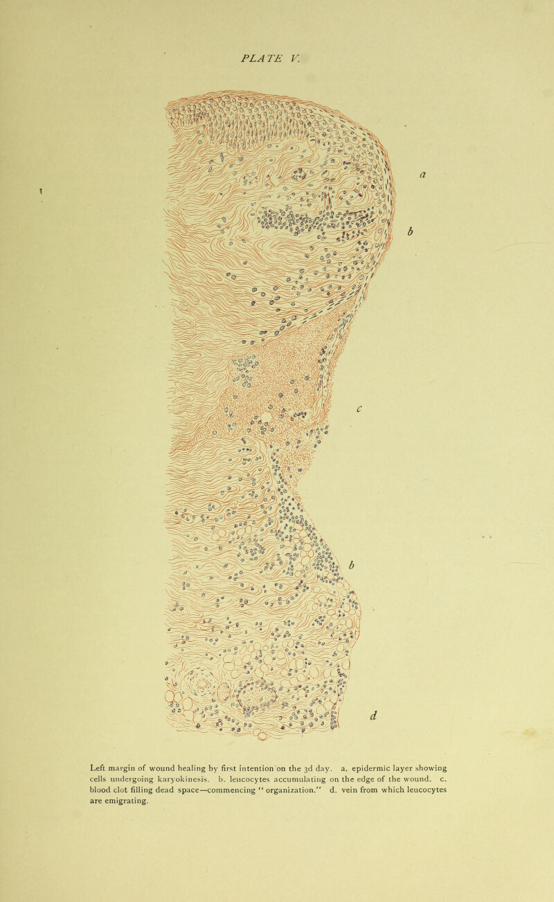 PLATE V. \ Left margin of wound healing by first intention on the 3d day. a. epidermic layer showing cells undergoing karyokinesis. b. leucocytes accumulating on the edge of the wound, c. blood clot filling dead space—commencing “ organization.” d. vein from which leucocytes are emigrating.