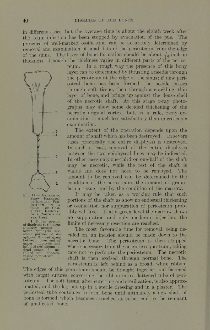 in different cases, but the average time is about the eighth week after the acute infection has been stopped by evacuation of the pus* The presence of well-marked ossification can be accurately determined by removal and examination of small bits of the periosteum from the edge of the sinus. The layer of bone formation should be about 3^ inch in thickness, although the thickness varies in different parts of the perios- teum. In a rough way the presence of this bony layer can be determined by thrusting a needle through the periosteum at the edge of the sinus; if new’ peri- osteal bone has been formed, the needle passes through soft tissue, then through a crackling, thin layer of bone, and brings up against the dense shell of the necrotic shaft. At this stage rc-ray photo- graphs may show’ some decided thickening of the necrotic original cortex, but, as a rule, .T-ray ex- amination is much less satisfactory than microscopic examination. The extent of the operation depends upon the amount of shaft wdiich has been destroyed. In severe cases practically the entire diaphysis is destroyed. In such a case, removal of the entire diaphysis betw’een the twm epiphyseal lines may be indicated. In other cases only one-third or one-half of the shaft may be necrotic, while the rest of the shaft is viable and does not need to be remoyed. The amount to be removed can be determined by the condition of the periosteum, the amount of granu- lation tissue, and by the condition of the marrow. It may be taken as a w’orking rule that such portions of the shaft as show^ no endosteal thickening or ossification nor suppuration of periosteum prob- ably will live. If at a given level the marrow shows no suppuration and only moderate injection, the limits of necessary resection are reached. The most favorable time for removal being de- cided on, an incision should be made dowm to the necrotic bone. The periosteum is then stripped where necessary from the necrotic sequestrum, taking care not to perforate the periosteum. The necrotic shaft is then excised through normal bone. The periosteum is left behind as a broad, wdiite ribbon. The edges of this periosteum should be brought together and fastened with catgut sutures, converting the ribbon into a flattened tube of peri- osteum. The soft tissue, after curetting and sterilization, is also approx- imated, and the leg put up in a sterile dressing and in a plaster. The periosteal tube continues to form bone until ultimately a new shaft of bone is formed, which becomes attached at either end to the renmant of unaffected bone. Fig. 14.—Diagram to Show Relation OF Infolded Per- iosteum in a C.ASE OF Com- plete Remov.al OF A Portion of the Tibia. 1, Upper portion of diaphysis to tibia cut squarely across; 2, lower epiphysis and small portion of di- aphysis; 3, dead space between lower end of upper diaphysis and infolded periosteum; 4, dead space. 5, un- folded and appro.xi- mated perio.steum; 6, sutures.