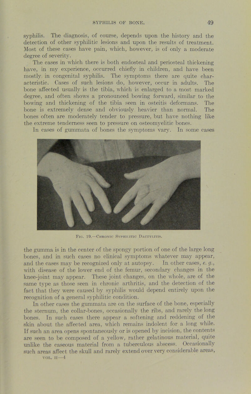 syphilis. The diagnosis, of course, depends upon the history and the detection of other syphilitic lesions and upon the results of treatment, ^lost of these cases have pain, which, however, is of only a moderate degree of severity. The cases in which there is both endosteal and periosteal thickening have, in my experience, occurred chiefly in children, and have been mostly, in congenital syphilis. The symptoms there are quite char- acteristic. Cases of such lesions do, however, occur in adults. The bone affected usually is the tibia, which is enlarged to a most marked degree, and often shows a pronounced bowing forward, similar to the bowing and thickening of the tibia seen in osteitis deformans. The bone is extremely dense and obviously heavier than normal. The bones often are moderately tender to pressure, but have nothing like the extreme tenderness seen to pressure on osteomyelitic bones. In cases of gummata of bones the symptoms vary. In some cases Fig. 19.--Chronic Syphii.itic Dactymtis. the gumma is in the center of the spongy portion of one of the large long bones, and in such cases no clinical symptoms whatever may appear, and the cases may be recognized only at autopsy. In other cases, e. g., with disease of the lower end of the femur, secondary changes in the knee-joint may appear. These joint changes, on the whole, are of the same type as those seen in chronic arthritis, and the detection of the fact that they were caused by syphilis would depend entirely upon the recognition of a general syphilitic condition. In other cases the gummata are on the surface of the bone, especially the sternum, the collar-bones, occasionally the ribs, and rarely the long bones. In such cases there appear a softening and reddening of the skin about the affected area, which remains indolent for a long while. If such an area opens spontaneously or is opened by incision, the contents are seen to be composed of a yellow, rather gelatinous material, quite unlike the caseous material from a tuberculous abscess. Occasionally such areas affect the skull and rarely extend over very considerable areas, VOL. II—4