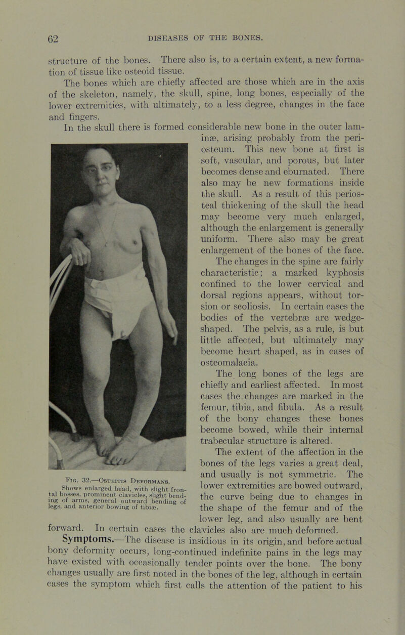 structure of the bones. There also is, to a certain extent, a new forma- tion of tissue like osteoid tissue. The bones which are chiefly affected are those which are in the axis of the skeleton, namely, the skull, spine, long bones, especially of the lower extremities, with ultimately, to a less degree, changes in the face and fingers. In the skull there is formed considerable new bone in the outer lam- inae, arising probably from the peri- osteum. This new bone at first is soft, vascular, and porous, but later becomes dense and eburnated. There also may be new formations inside the skull. As a result of this perios- teal thickening of the skull the head may become very much enlarged, although the enlargement is generally uniform. There also may be great enlargement of the bones of the face. The changes in the spine are fairly characteristic; a marked kyphosis confined to the lower cervical and dorsal regions appears, without tor- sion or scoliosis. In certain cases the bodies of the vertebrae are wedge- shaped. The pelvis, as a rule, is but little affected, but ultimately may become heart shaped, as in cases of osteomalacia. The long bones of the legs are chiefly and earliest affected. In most cases the changes are marked in the femur, tibia, and fibula. As a result of the bony changes these bones become bowed, while their internal trabecular structure is altered. The extent of the affection in the bones of the legs varies a great deal, and usually is not symmetric. The lower extremities are bowed outAvard, the curve being due to changes in the shape of the femur and of the lower leg, and also usually are bent forward. In certain cases the clavicles also are much deformed. Symptoms. The disease is insidious in its origin, and before actual bony deformity occurs, long-continued indefinite pains in the legs may have existed with occasionally tender points over the bone. The bony changes usually are first noted in the bones of the leg, although in certain cases the symptom which first calls the attention of the patient to his Fig. 32.—Osteitis Deformans. Shows enlarged head, with slight fron- tal bosses, prominent clavicles, slight bend- ing of arms, general outward bending of legs, and anterior bowing of tibite.