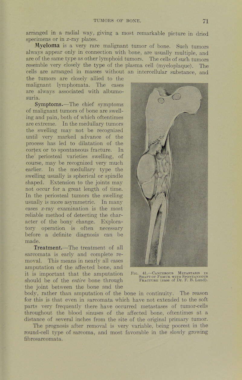 arranged in a radial way, giving a most remarkable picture in dried specimens or in x-ray plates. Myeloma is a very rare malignant tumor of bone. Such tumors always appear only in connection with bone, are usually multiple, and are of the same type as other lymphoid tumors. The cells of such tumors resemble very closely the type of the plasma cell (myeloplaque). The cells are arranged m masses without an intercellular substance, and the tumors are closely allied to the malignant lymphomata. The cases are always associated with albumo- suria. Symptoms.—The chief symptoms of malignant tumors of bone are swell- ing and pain, both of which oftentimes are extreme. In the medullary tumors the swelling may not be recognized until very marked advance of the process has led to dilatation of the cortex or to spontaneous fracture. In the periosteal varieties swelling, of course, may be recognized very much earlier. In the medullary type the swelling usually is spherical or spindle shaped. Extension to the joints may not occur for a great length of time. In the periosteal tumors the swelling usually is more asymmetric. In many cases x-ray examination is the most reliable method of detecting the char- acter of the bony change. Explora- tory operation is often necessary before a definite diagnosis can be made. Treatment.—The treatment of all sarcomata is early and complete re- moval. This means in nearly all cases amputation of the affected bone, and it is important that the amputation should be of the entire bone through the joint between the bone and the body, rather than amputation of the bone in continuity. The reason for this is that even in sarcomata which have not extended to the soft parts ver}^ frecjuently there have occurred metastases of tumor-cells throughout the blood sinuses of the affected bone, oftentimes at a distance of several inches from the site of the original primary tumor. The prognosis after removal is very variable, being poorest in the round-cell type of sarcoma, and most favorable in the slowly growing fibrosarcomata. Fig. 41.—Cancerous Metastasis in Shaft OF Femur with Spontaneous Fracture (case of Dr. F. B. Lund).