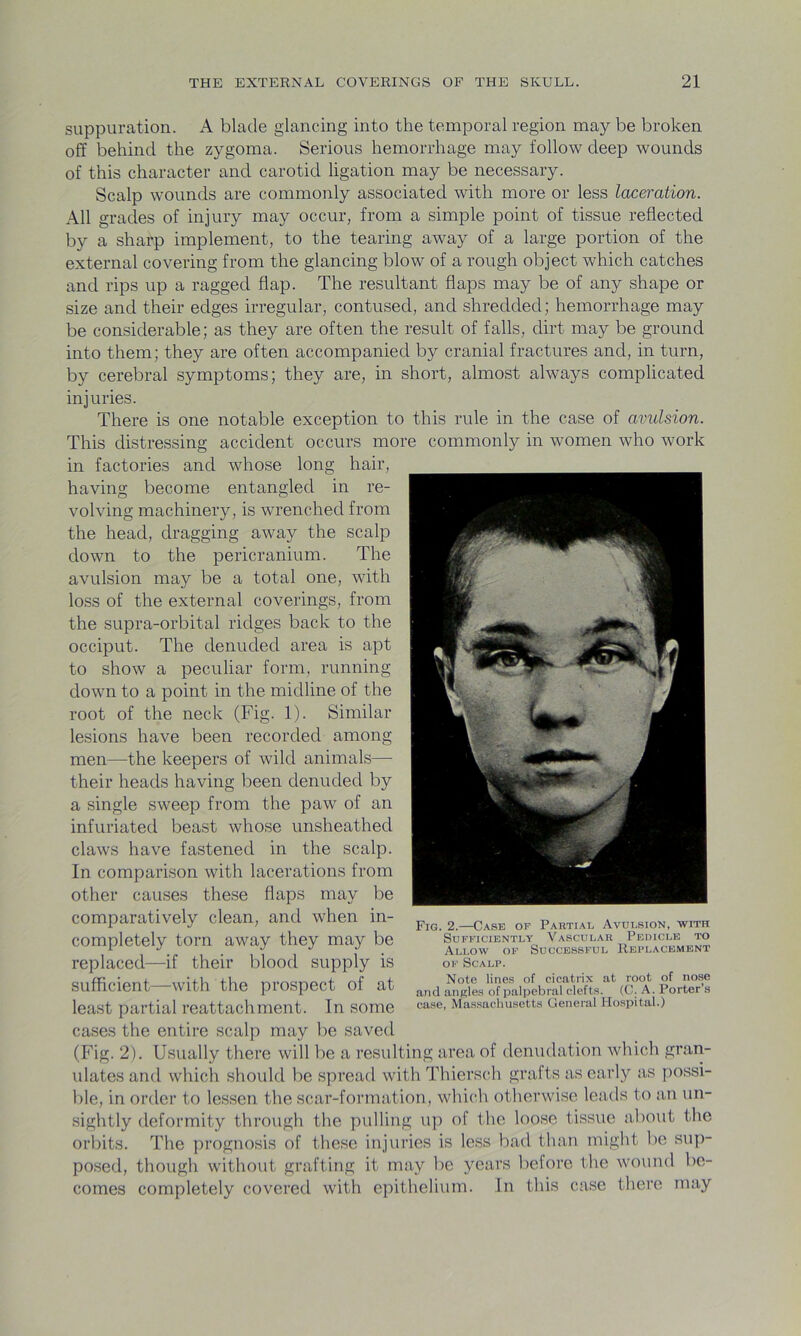 suppuration. A blade glancing into the temporal region may be broken off behind the zygoma. Serious hemorrhage may follow deep wounds of this character and carotid ligation may be necessary. Scalp wounds are commonly associated with more or less laceration. All grades of injury may occur, from a simple point of tissue reflected by a sharp implement, to the tearing away of a large portion of the external covering from the glancing blow of a rough object which catches and rips up a ragged flap. The resultant flaps may be of any shape or size and their edges irregular, contused, and shredded; hemorrhage may be considerable; as they are often the result of falls, dirt may be ground into them; they are often accompanied by cranial fractures and, in turn, by cerebral symptoms; they are, in short, almost always complicated injuries. There is one notable exception to this rule in the case of avulsion. This distressing accident occurs more commonly in women who work in factories and whose long hair, having become entangled in re- volving machinery, is wrenched from the head, dragging away the scalp down to the pericranium. The avulsion may be a total one, with loss of the external coverings, from the supra-orbital ridges back to the occiput. The denuded area is apt to show a peculiar form, running down to a point in the midline of the root of the neck (Fig. 1). Similar lesions have been recorded among men—the keepers of wild animals— their heads having been denuded by a single sweep from the paw of an infuriated beast whose unsheathed claws have fastened in the scalp. In comparison with lacerations from other causes these flaps may be comparatively clean, and when in- completely torn away they may be replaced—if their blood supply is sufficient—with the prospect of at least partial reattachment. In some cases the entire scalp may be saved (Fig. 2). Usually there will be a resulting area of denudation which gran- ulates and which should be spread with Thiersch grafts as early as possi- ble, in order to lessen the scar-formation, which otherwise leads to an un- sightly deformity through the pulling up of the loose tissue about the orbits. The prognosis of these injuries is less bad than might be sup- posed, though without grafting it may be years before the wound be- comes completely covered with epithelium. In this case there may Fig. 2.—Case of Partial Avulsion, with Sufficiently Vascular Pedicle to Allow of Successful Replacement of Scalp. Note lines of cicatrix at root of nose and angles of palpebral clefts. (C. A. Porter’s case, Massachusetts General Hospital.)