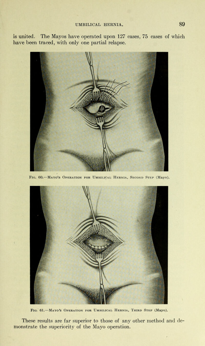 is united. The May os have operated upon 127 cases, 75 cases of which have been traced, with only one partial relapse. Fig. 60.—Mayo’s Operation for Umbilical Hernia, Second Step (Mayo). Fig. 61.—Mayo’s Operation for Umbilical Hernia, Third Step (Mayo). These results are far superior to those of any other method and de- monstrate the superiority of the Mayo operation.