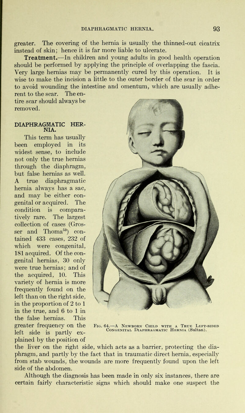 greater. The covering of the hernia is usually the thinned-out cicatrix instead of skin; hence it is far more liable to ulcerate. Treatment.—In children and young adults in good health operation should be performed by applying the principle of overlapping the fascia. Very large hernias may be permanently cured by this operation. It is wise to make the incision a little to the outer border of the scar in order to avoid wounding the intestine and omentum, which are usually adhe- rent to the scar. The en- tire scar should always be removed. DIAPHRAGMATIC HER- NIA. This term has usually been employed in its widest sense, to include not only the true hernias through the diaphragm, but false hernias as well. A true diaphragmatic hernia always has a sac, and may be either con- genital or acquired. The condition is compara- tively rare. The largest collection of cases (Gros- ser and Thoma53) con- tained 433 cases, 232 of which were congenital, 181 acquired. Of the con- genital hernias, 30 only were true hernias; and of the acquired, 10. This variety of hernia is more frequently found on the left than on the right side, in the proportion of 2 to 1 in the true, and 6 to 1 in the false hernias. This greater frequency On the Fig. 64—A Newborn Child with a True Left-sided i e. • i • Congenital Diaphragmatic Hernia (Sultan). lelt side is partly ex- plained by the position of the liver on the right side, which acts as a barrier, protecting the dia- phragm, and partly by the fact that in traumatic direct hernia, especially from stab wounds, the wounds are more frequently found upon the left side of the abdomen. Although the diagnosis has been made in only six instances, there are certain fairly characteristic signs which should make one suspect the