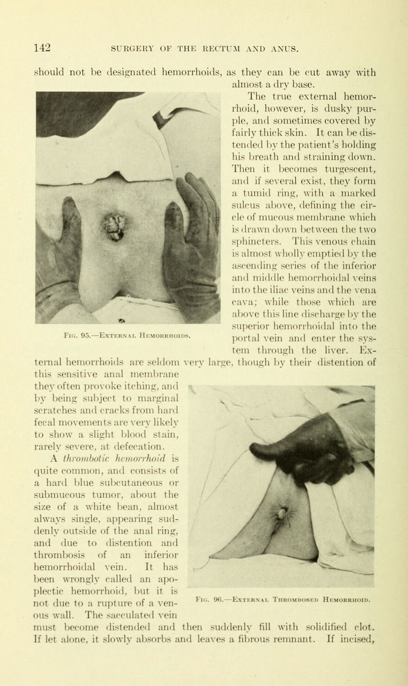 should not be designated hemorrhoids, as they can be cut away with almost a dry base. The true external hemor- rhoid, however, is dusky pur- ple, and sometimes covered by fairly thick skin. It can be dis- tended by the patient’s holding his breath and straining down. Then it becomes turgescent, and if several exist, they form a tumid ring, with a marked sulcus above, defining the cir- cle of mucous membrane which is drawn down between the two sphincters. This venous chain is almost wholly empt ied by the ascending series of the inferior and middle hemorrhoidal veins into the iliac veins and the vena cava; while those which are above this line discharge by the superior hemorrhoidal into the Fig. 95.—External Hemorrhoids. portal vein and enter the Sys- tem through the liver. Ex- ternal hemorrhoids are seldom very large, though bv their distention of this sensitive anal membrane they often provoke itching, and by being subject to marginal scratches and cracks from hard fecal movements are very likely to show a slight blood stain, rarely severe, at defecation. A thrombotic hemorrhoid is quite common, and consists of a hard blue subcutaneous or submucous tumor, about the size of a white bean, almost always single, appearing sud- denly outside of the anal ring, and due to distention and thrombosis of an inferior hemorrhoidal vein. It has been wrongly called an apo- plectic hemorrhoid, but it is not due to a rupture of a ven- ous wall. The sacculated vein must become distended and then suddenly fill with solidified clot. If let alone, it slowly absorbs and leaves a fibrous remnant. If incised, Fig. 96.—External Thromhosed Hemorrhoid.