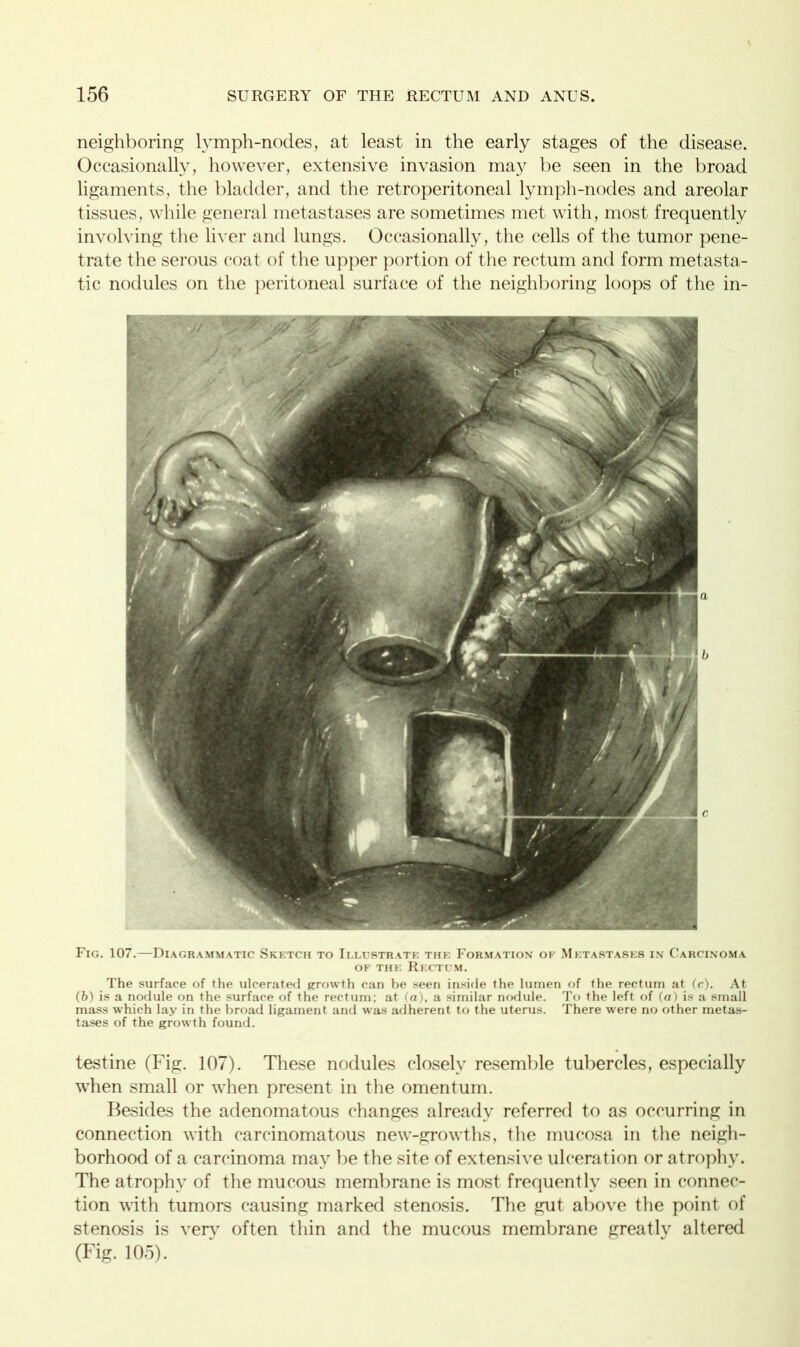 neighboring lymph-nodes, at least in the early stages of the disease. Occasionally, however, extensive invasion may be seen in the broad ligaments, the bladder, and the retroperitoneal lymph-nodes and areolar tissues, while general metastases are sometimes met with, most frequently involving the liver and lungs. Occasionally, the cells of the tumor pene- trate the serous coat of the upper portion of the rectum and form metasta- tic nodules on the peritoneal surface of the neighboring loops of the in- Fig. 107.—Diagrammatic Sketch to Illustrate the Formation of Metastases in Carcinoma of the Rectum. The surface of the ulcerated growth can be seen inside the lumen of the rectum at (c). At (6) is a nodule on the surface of the rectum; at (a), a similar nodule. To the left of (a) is a small mass which lay in the broad ligament and was adherent to the uterus. There were no other metas- tases of the growth found. testine (Fig. 107). These nodules closely resemble tubercles, especially when small or when present in the omentum. Besides the adenomatous changes already referred to as occurring in connection with carcinomatous new-growths, the mucosa in the neigh- borhood of a carcinoma may be the site of extensive ulceration or atrophy. The atrophy of the mucous membrane is most frequently seen in connec- tion with tumors causing marked stenosis. The gut above the point of stenosis is very often thin and the mucous membrane greatly altered (Fig. 105).