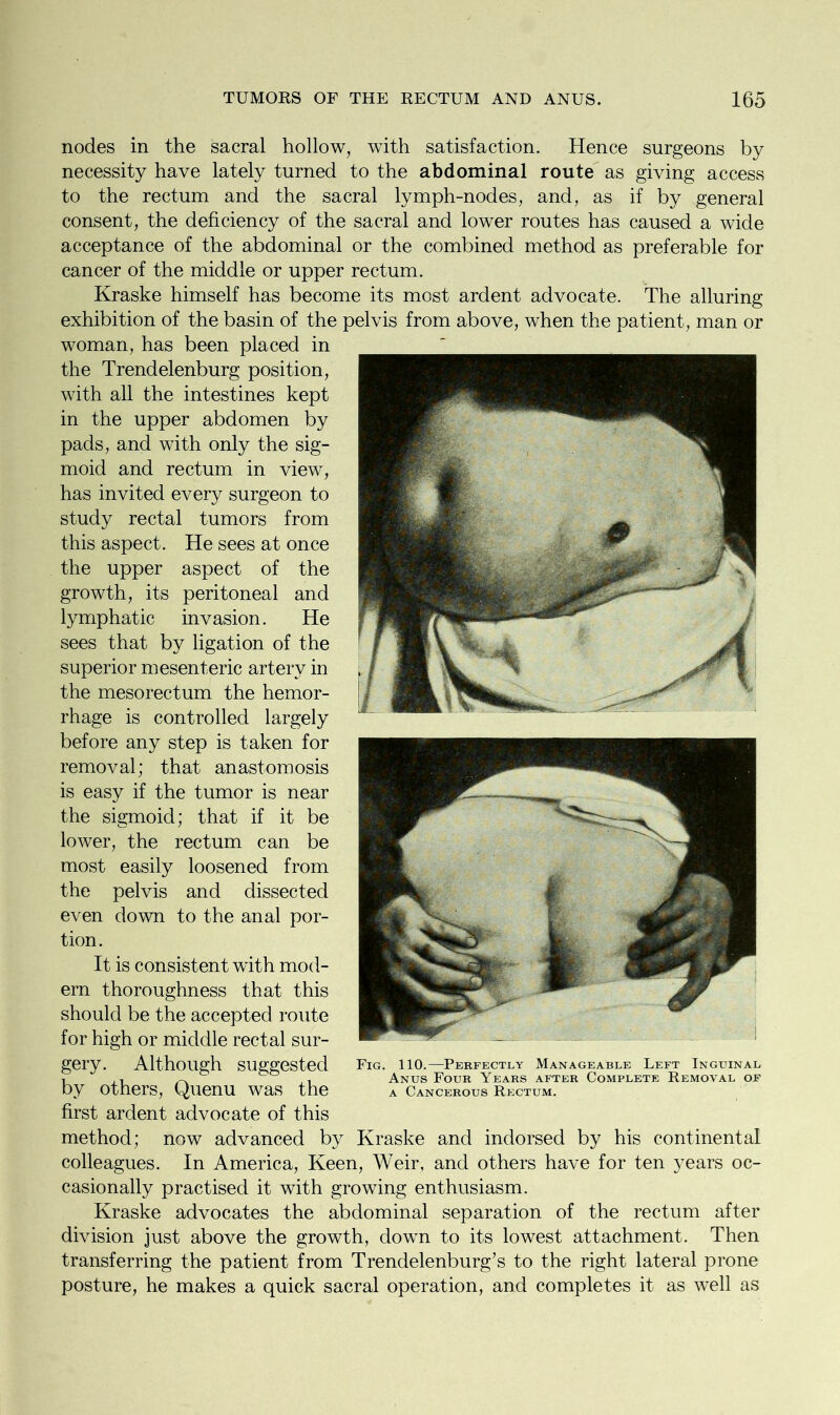 nodes in the sacral hollow, with satisfaction. Hence surgeons by necessity have lately turned to the abdominal route as giving access to the rectum and the sacral lymph-nodes, and, as if by general consent, the deficiency of the sacral and lower routes has caused a wide acceptance of the abdominal or the combined method as preferable for cancer of the middle or upper rectum. Kraske himself has become its most ardent advocate. The alluring exhibition of the basin of the pelvis from above, when the patient, man or woman, has been placed in the Trendelenburg position, with all the intestines kept in the upper abdomen by pads, and with only the sig- moid and rectum in view, has invited every surgeon to study rectal tumors from this aspect. He sees at once the upper aspect of the growth, its peritoneal and lymphatic invasion. He sees that by ligation of the superior mesenteric artery in the mesorectum the hemor- rhage is controlled largely before any step is taken for removal; that anastomosis is easy if the tumor is near the sigmoid; that if it be lower, the rectum can be most easily loosened from the pelvis and dissected even down to the anal por- tion. It is consistent with mod- ern thoroughness that this should be the accepted route for high or middle rectal sur- gery. Although suggested by others, Quenu was the first ardent advocate of this method; now advanced by Kraske and indorsed by his continental colleagues. In America, Keen, Weir, and others have for ten years oc- casionally practised it with growing enthusiasm. Kraske advocates the abdominal separation of the rectum after division just above the growth, down to its lowest attachment. Then transferring the patient from Trendelenburg’s to the right lateral prone posture, he makes a quick sacral operation, and completes it as well as Fig. 110.—Perfectly Manageable Left Inguinal Anus Four Years after Complete Removal of a Cancerous Rectum.