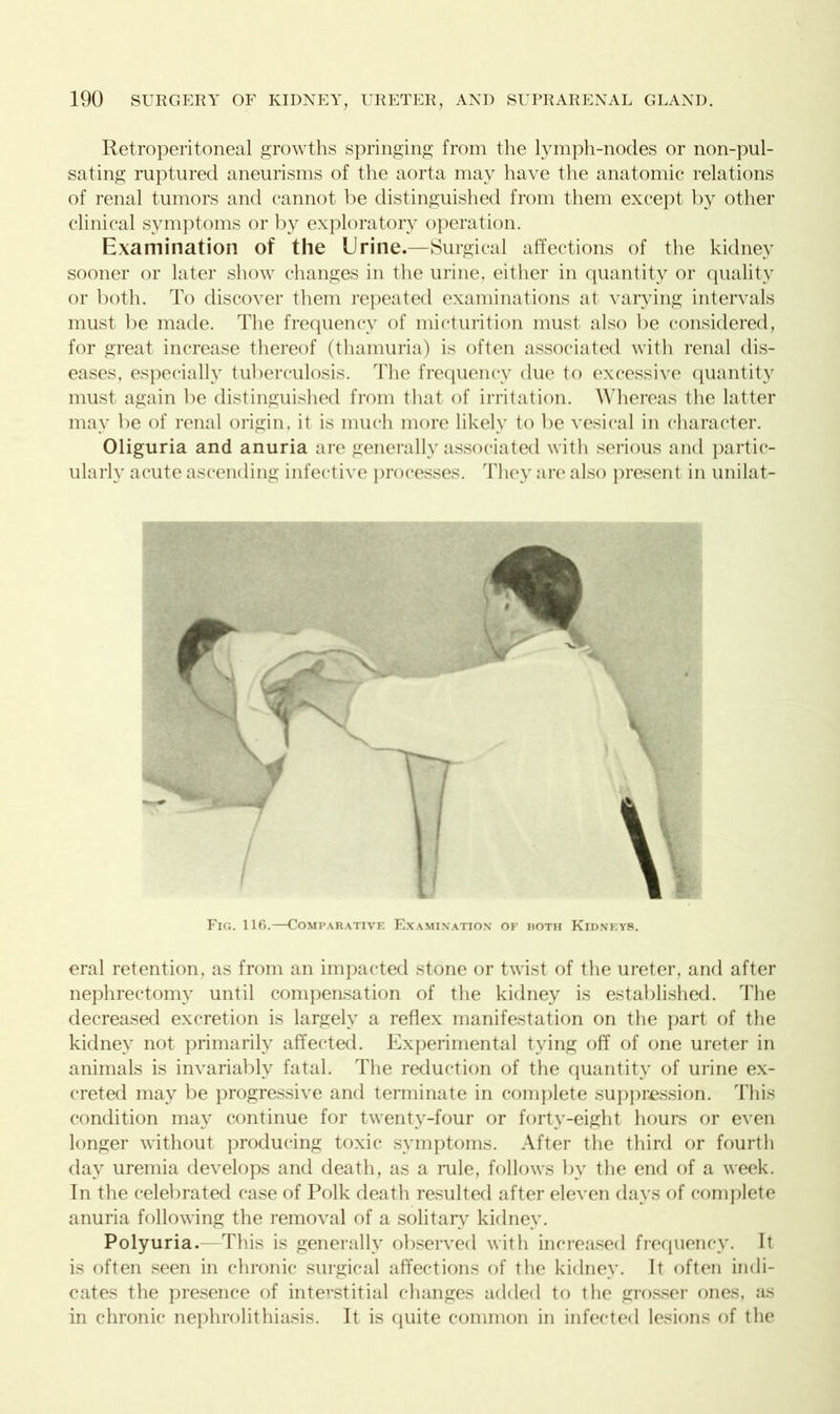 Retroperitoneal growths springing from the lymph-nodes or non-pul- sating ruptured aneurisms of the aorta may have the anatomic relations of renal tumors and cannot be distinguished from them except by other clinical symptoms or by exploratory operation. Examination of the Urine.—Surgical affections of the kidney sooner or later show changes in the urine, either in quantity or quality or both. To discover them repeated examinations at varying intervals must be made. The frequency of micturition must also be considered, for great increase thereof (thamuria) is often associated with renal dis- eases, especially tuberculosis. The frequency due to excessive quantity must again be distinguished from that of irritation. Whereas the latter may be of renal origin, it is much more likely to be vesical in character. Oliguria and anuria are generally associated with serious and partic- ularly acute ascending infective processes. They are also present in unilat- Fig. 116.—Comparative Examination of hoth Kidneys. eral retention, as from an impacted stone or twist of the ureter, and after nephrectomy until compensation of the kidney is established. The decreased excretion is largely a reflex manifestation on the part of the kidney not primarily affected. Experimental tying off of one ureter in animals is invariably fatal. The reduction of the quantity of urine ex- creted may be progressive and terminate in complete suppression. This condition may continue for twenty-four or forty-eight hours or even longer without producing toxic symptoms. After the third or fourth day uremia develops and death, as a rule, follows by the end of a week. In the celebrated case of Polk death resulted after eleven days of complete anuria following the removal of a solitary kidney. Polyuria.—This is generally observed with increased frequency. It is often seen in chronic surgical affections of the kidney. It often indi- cates the presence of interstitial changes added to the grosser ones, as in chronic nephrolithiasis. It is quite common in infected lesions of the