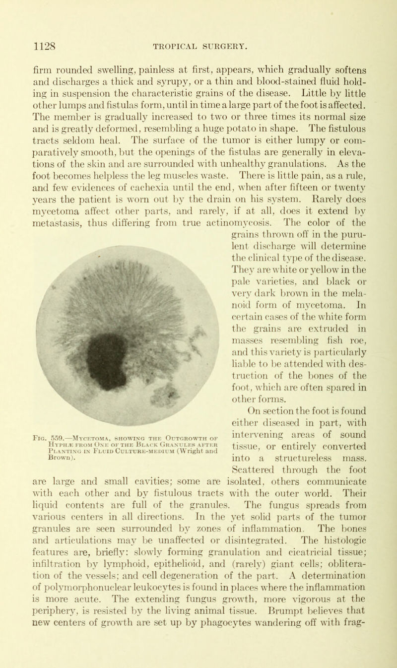 firm rounded swelling, painless at first, appears, which gradually softens and discharges a thick and syrupy, or a thin and blood-stained fluid hold- ing in suspension the characteristic grains of the disease. Little by little other lumps and fistulas form, until in time a large part of the foot is affected. The member is gradually increased to two or three times its normal size and is greatly deformed, resembling a huge potato in shape. The fistulous tracts seldom heal. The surface of the tumor is either lumpy or com- paratively smooth, but the openings of the fistulas are generally in eleva- tions of the skin and are surrounded with unhealthy granulations. As the foot becomes helpless the leg muscles waste. There is little pain, as a rule, and few evidences of cachexia until the end, when after fifteen or twenty years the patient is worn out by the drain on his system. Rarely does mycetoma affect other parts, and rarely, if at all, does it extend bv metastasis, thus differing from true actinomycosis. The color of the are large and small cavities; some are isolated, others communicate with each other and by fistulous tracts with the outer world. Their liquid contents are full of the granules. The fungus spreads from various centers in all directions. In the yet solid parts of the tumor granules are seen surrounded by zones of inflammation. The bones and articulations may be unaffected or disintegrated. The histologic features are, briefly: slowly forming granulation and cicatricial tissue; infiltration by lymphoid, epithelioid, and (rarely) giant cells; oblitera- tion of the vessels; and cell degeneration of the part. A determination of polymorphonuclear leukocytes is found in places where the inflammation is more acute. The extending fungus growth, more vigorous at the periphery, is resisted by the living animal tissue. Brumpt believes that new centers of growth are set up by phagocytes wandering off with frag- grains thrown off in the puru- lent discharge will determine the clinical type of the disease. They are white or yellow in the pale varieties, and black or very dark brown in the mela- noid form of mycetoma. In certain cases of the white form the grains are extruded in masses resembling fish roe, and this variety is particularly liable to be attended with des- truction of the bones of the foot, which are often spared in other forms. Fig.  ~ ()n section the foot is found either diseased in part, with intervening areas of sound tissue, or entirely converted into a structureless mass. Scattered through the foot