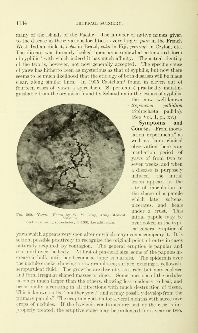 many of the islands of the Pacific. The number of native names given to the disease in these various localities is very large; plan in the French West Indian dialect, boba in Brazil, coko in Fiji, paranyi in Ceylon, etc. The disease was formerly looked upon as a somewhat attenuated form of syphilis,1 with which indeed it has much affinity. The actual identity of the two is, however, not now generally accepted. The specific cause of yaws has hitherto been as mysterious as that of syphilis, but now there seems to be much likelihood that the etiology of both diseases will be made clear, along similar lines. In 1905 Castellani2 found in eleven out of fourteen cases of yaws, a spirochaete (S. pertenuis) practically indistin- guishable from the organism found by Schaudinn in the lesions of syphilis, the now well-known treponema pallidum (Spirochaeta pallida). (See \01. I, pi. xv.) Symptoms and Course.—From inocu- lation experiments6 as well as from clinical observation there is an incubation period of yaws of from two to seven weeks, and when a disease is purposely induced, the initial lesion appears at the site of inoculation in the shape of a papule which later softens, ulcerates, and heals under a crust. This initial papule may be overlooked in the typi- cal general eruption of yaws which appears very soon after or which may even accompany it. It is seldom possible positively to recognize the original point of entry in cases naturally acquired by contagion. The general eruption is papular and scattered over the body. At first of pin-head size, some of the papules in- crease in bulk until they become as large as marbles. The epidermis over the nodule cracks, showing a raw granulating surface, exuding a yellowish, seropurulent fluid. The growths are discrete, as a rule, but may coalesce and form irregular shaped masses or rings. Sometimes one of the nodules becomes much larger than the others, showing less tendency to heal, and occasionally ulcerating in all directions with much destruction of tissue. This is 1 mown as the “mother yaw.” and it may possibly develop from the primary papule.2 The eruption goes on for several months with successive crops of nodules. If the hygienic conditions are bad or the case is im- properly treated, the eruptive stage may be prolonged for a year or two. Fig. 560.—Yaws. (Photo by W. M. Gray, Army Medical Museum). Section showing spirochetes; X 1500, Levaditi stain.