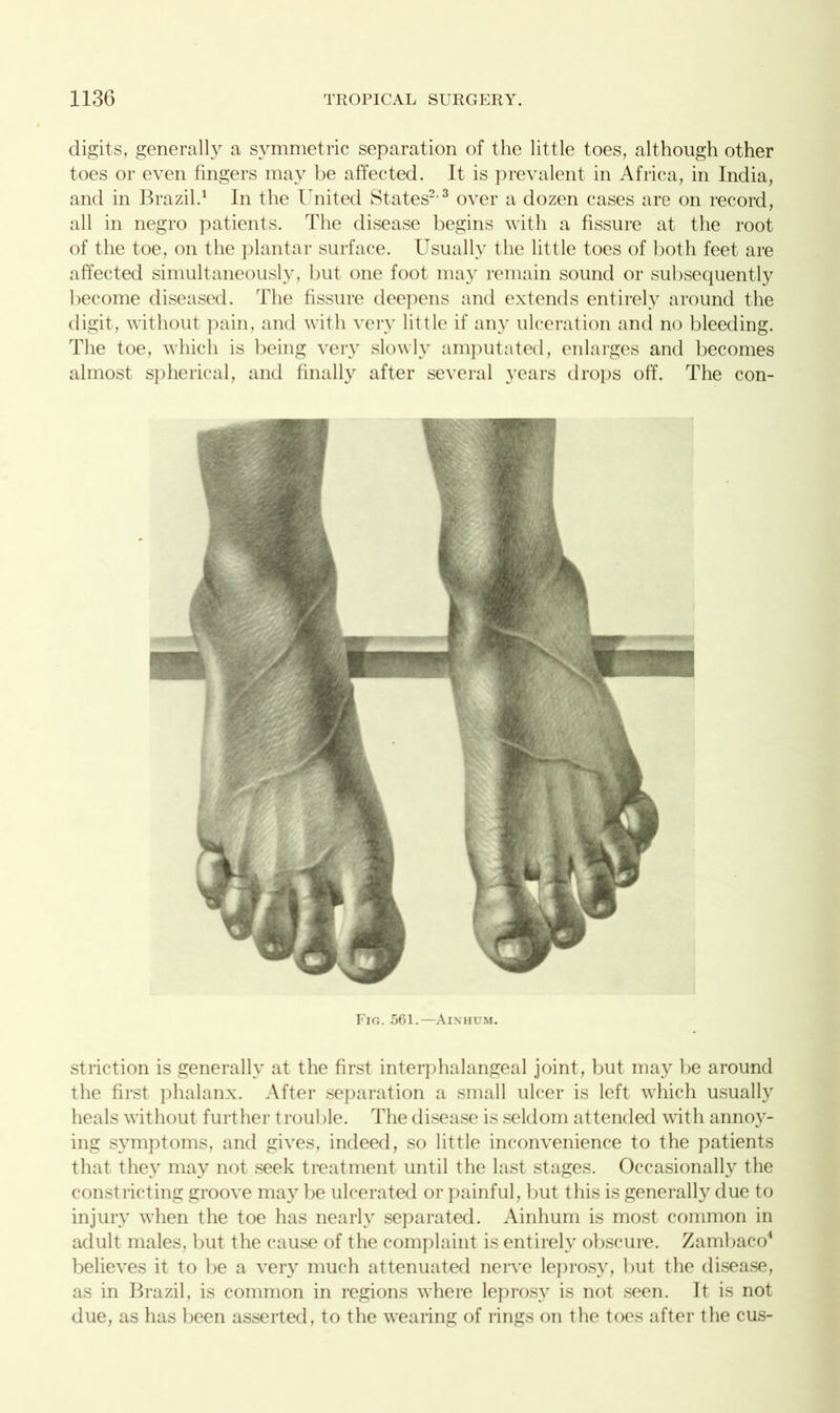 digits, generally a symmetric separation of the little toes, although other toes or even fingers may be affected. It is prevalent in Africa, in India, and in Brazil.1 In the United States2,3 over a dozen cases are on record, all in negro patients. The disease begins with a fissure at the root of the toe, on the plantar surface. Usually the little toes of both feet are affected simultaneously, but one foot may remain sound or subsequently become diseased. The fissure deepens and extends entirely around the digit, without pain, and with very little if any ulceration and no bleeding. The toe, which is being very slowly amputated, enlarges and becomes almost spherical, and finally after several years drops off. The con- Fio. 561.—Ainhum. strietion is generally at the first interphalangeal joint, but may lie around the first phalanx. After separation a small ulcer is left which usually heals without further trouble. The disease is seldom attended with annoy- ing symptoms, and gives, indeed, so little inconvenience to the patients that they may not seek treatment until the last stages. Occasionally the constricting groove may be ulcerated or painful, but this is generally due to injury when the toe has nearly separated. Ainhum is most common in adult males, but the cause of the complaint is entirely obscure. Zambaco4 believes it to be a very much attenuated nerve leprosy, but the disease, as in Brazil, is common in regions where leprosy is not seen. It is not due, as has been asserted, to the wearing of rings on the toes after the cus-