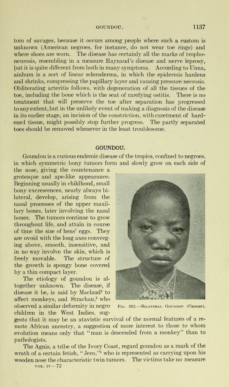 tom of savages, because it occurs among people where such a custom is unknown (American negroes, for instance, do not wear toe rings) and where shoes are worn. The disease has certainly all the marks of tropho- neurosis, resembling in a measure Raynaud 7s disease and nerve leprosy, but it is quite different from both in many symptoms. According to Unna, ainhum is a sort of linear scleroderma, in which the epidermis hardens and shrinks, compressing the papillary layer and causing pressure necrosis. Obliterating arteritis follows, with degeneration of all the tissues of the toe, including the bone which is the seat of rarefying ostitis. There is no treatment that will preserve the toe after separation has progressed to any extent, but in the unlikely event of making a diagnosis of the disease in its earlier stage, an incision of the constriction, with curetment of hard- ened tissue, might possibly stop further progress. The partly separated toes should be removed whenever in the least troublesome. GOUNDOU. Goundou is a curious endemic disease of the tropics, confined to negroes, in which symmetric bony tumors form and slowly grow on each side of the nose, giving the countenance a grotesque and ape-like appearance; Beginning usually in childhood, small bony excrescences, nearly always bi- lateral, develop, arising from the nasal processes of the upper maxil- lary bones, later involving the nasal bones. The tumors continue to grow throughout life, and attain in course of time the size of hens7 eggs. They are ovoid with the long axes converg- ing above, smooth, insensitive, and in no way involve the skin, which is freely movable. The structure of the growth is spongy bone covered by a thin compact layer. The etiology of goundou is al- together unknown. The disease, if disease it be, is said by Maclaud1 to affect monkeys, and Strachan,2 who observed a similar deformity in negro children in the West Indies, sug- gests that it may be an atavistic survival of the normal features of a re- mote African ancestry, a suggestion of more interest to those to whom evolution means only that “man is descended from a monkey77 than to pathologists. The Agnis, a tribe of the Ivory Coast, regard goundou as a mark of the wrath of a certain fetish, “ Jero,771 who is represented as carrying upon his wooden nose the characteristic twin tumors. The victims take no measure yol. iv—72 Fig. 562.—Bilateral Gotjndou (Cannae).