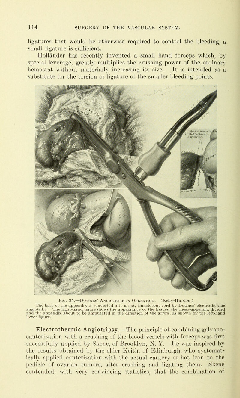 ligatures that would be otherwise required to control the bleeding, a small ligature is sufficient. Hollander has recently invented a small hand forceps which, by special leverage, greatly multiplies the crushing power of the ordinary hemostat without materially increasing its size. It is intended as a substitute for the torsion or ligature of the smaller bleeding points. Fig. 35.—Downes’ Angiotribe in Operation. (Kelly-Hurdon.) The base of the appendix is converted into a flat, translucent cord by Downes’ electrothermic angiotribe. The right-hand figure shows the appearance of the tissues, the meso-appendix divided and the appendix about to be amputated in the direction of the arrow, as shown by the left-hand lower figure. Electrothermic Angiotripsy.—The principle of combining galvano- cauterization with a crushing of the blood-vessels with forceps was first successfully applied by Skene, of Brooklyn, N. Y. He was inspired by the results obtained by the elder Keith, of Edinburgh, who systemat- ically applied cauterization with the actual cautery or hot iron to the pedicle of ovarian tumors, after crushing and ligating them. Skene contended, with very convincing statistics, that the combination of