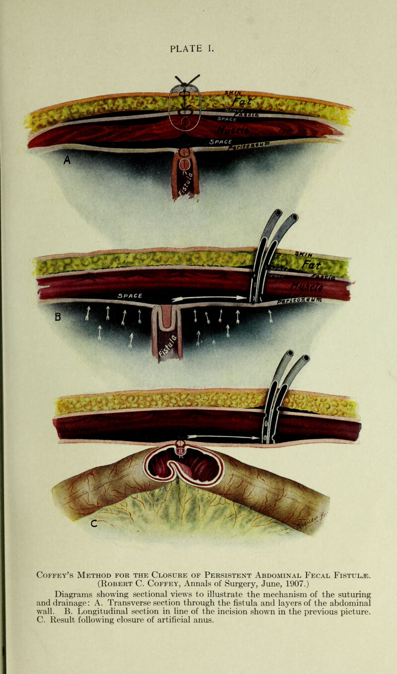 PLATE I. Coffey’s Method for the Closure of Persistent Abdominal Fecal Fistula. (Robert C. Coffey, Annals of Surgery, June, 1907.) Diagrams showing sectional views to illustrate the mechanism of the suturing and drainage: A. Transverse section through the fistula and layers of the abdominal wall. B. Longitudinal section in line of the incision shown in the previous picture. C. Result following closure of artificial anus.