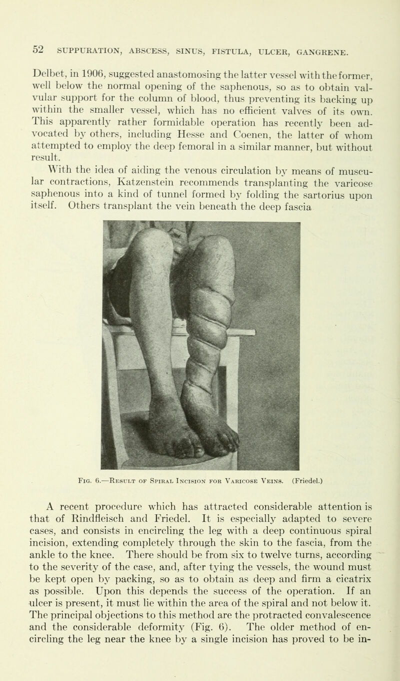 Delbet, in 1906, suggested anastomosing the latter vessel with the former, well below the normal opening of the saphenous, so as to obtain val- vular support for the column of blood, thus preventing its backing up within the smaller vessel, which has no efficient valves of its own. This apparently rather formidable operation has recently been ad- vocated by others, including Hesse and Coenen, the latter of whom attempted to employ the deep femoral in a similar manner, but without result. With the idea of aiding the venous circulation by means of muscu- lar contractions, Katzenstein recommends transplanting the varicose saphenous into a kind of tunnel formed by folding the sartorius upon itself. Others transplant the vein beneath the deep fascia Fig. 6.—Result of Spiral Incision for Varicose Veins. (Friedel.) A recent procedure which has attracted considerable attention is that of Rindfleisch and Friedel. It is especially adapted to severe cases, and consists in encircling the leg with a deep continuous spiral incision, extending completely through the skin to the fascia, from the ankle to the knee. There should be from six to twelve turns, according to the severity of the case, and, after tying the vessels, the wound must be kept open by packing, so as to obtain as deep and firm a cicatrix as possible. Upon this depends the success of the operation. If an ulcer is present, it must lie within the area of the spiral and not below it. The principal objections to this method are the protracted convalescence and the considerable deformity (Fig. 6). The older method of en- circling the leg near the knee by a single incision has proved to be in-