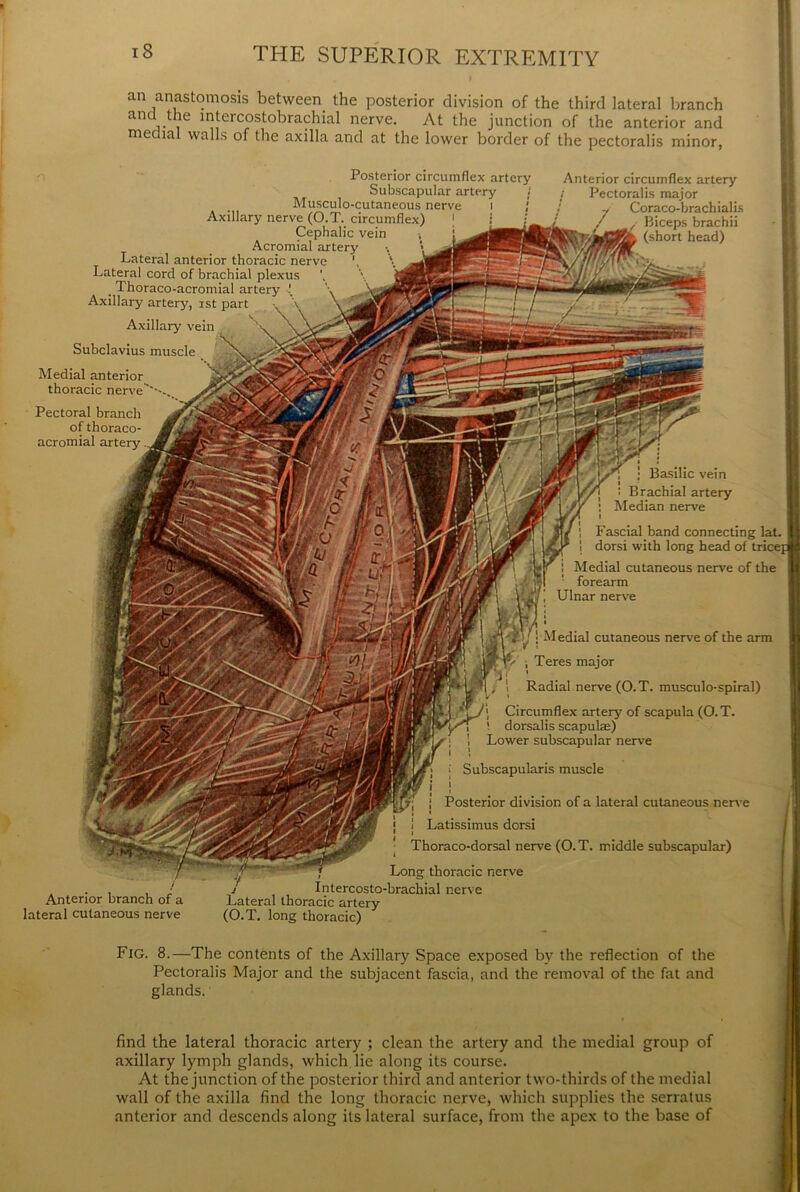 an anastomosis between the posterior division of the third lateral branch and .the intercostobrachial nerve. At the junction of the anterior and medial walls of the axilla and at the lower border of the pectoralis minor, n .rostenor circumflex artery Subscapular artery Musculo-cutaneous nerve i Axillary nerve (O.T. circumflex) Cephalic vein Acromial artery Lateral anterior thoracic nerve Lateral cord of brachial plexus . Thoraco-acromial artery i Axillary artery, ist part Axillary vein Subclavius muscle Medial anterior thoracic nerve Pectoral branch of thoraco- acromial artery Anterior circumflex artery Pectoralis major Coraco-brach ial is Biceps brachii (short head) | Basilic vein ' Brachial artery Median nerve Fascial band connecting lat. dorsi with long head of trice] Medial cutaneous nerve of the forearm Ulnar nerve [ Medial cutaneous nerve of the arm i Teres major I Radial nerve (O.T. musculo-spiral) > Circumflex artery of scapula (O. T. ! dorsalis scapulae) Lower subscapular nerve Subscapularis muscle | Posterior division of a lateral cutaneous nerve Latissimus dorsi Thoraco-dorsal nerve (O. T. middle subscapular) Anterior branch of a lateral cutaneous nerve Long thoracic nerve Intercosto-brachial nerve Lateral thoracic artery (O.T. long thoracic) Fig. 8.—The contents of the Axillary Space exposed by the reflection of the Pectoralis Major and the subjacent fascia, and the removal of the fat and glands. find the lateral thoracic artery ; clean the artery and the medial group of axillary lymph glands, which lie along its course. At the junction of the posterior third and anterior two-thirds of the medial wall of the axilla find the long thoracic nerve, which supplies the serratus anterior and descends along its lateral surface, from the apex to the base of