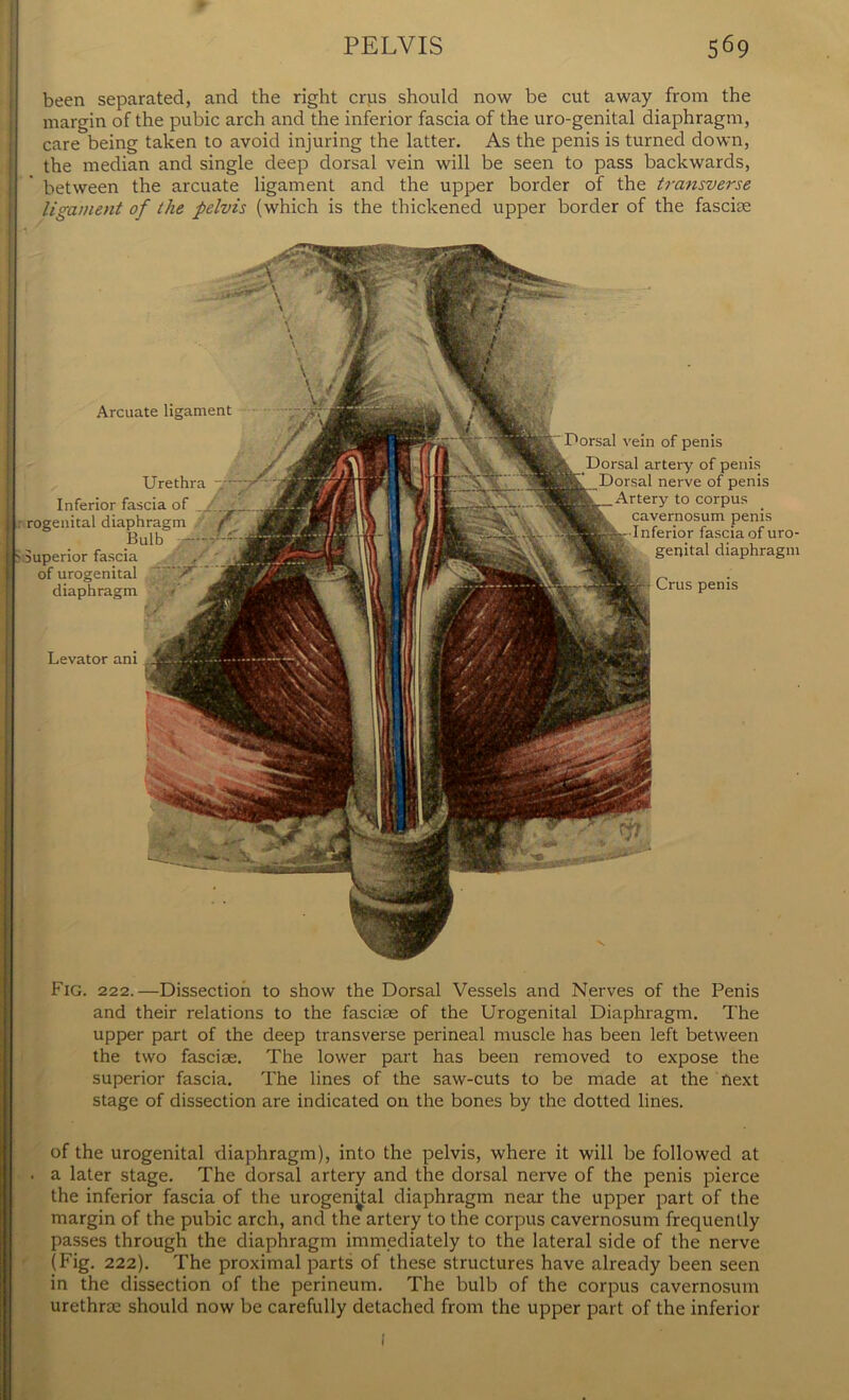 been separated, and the right crus should now be cut away from the margin of the pubic arch and the inferior fascia of the uro-genital diaphragm, care being taken to avoid injuring the latter. As the penis is turned down, the median and single deep dorsal vein will be seen to pass backwards, between the arcuate ligament and the upper border of the transverse ligament of the pelvis (which is the thickened upper border of the fasciae Arcuate ligament Urethra Inferior fascia of rogenital diaphragm Bulb ~ Superior fascia of urogenital diaphragm § Levator ani Dorsal vein of penis Dorsal artery of penis Dorsal nerve of penis Artery to corpus cavernosum penis Inferior fascia of uro genital diaphragn Crus penis Fig. 222.—Dissection to show the Dorsal Vessels and Nerves of the Penis and their relations to the fasciae of the Urogenital Diaphragm. The upper part of the deep transverse perineal muscle has been left between the two fasciae. The lower part has been removed to expose the superior fascia. The lines of the saw-cuts to be made at the next stage of dissection are indicated on the bones by the dotted lines. of the urogenital diaphragm), into the pelvis, where it will be followed at ■ a later stage. The dorsal artery and the dorsal nerve of the penis pierce the inferior fascia of the urogenital diaphragm near the upper part of the margin of the pubic arch, and the artery to the corpus cavernosum frequently passes through the diaphragm immediately to the lateral side of the nerve (Fig. 222). The proximal parts of these structures have already been seen in the dissection of the perineum. The bulb of the corpus cavernosum urethne should now be carefully detached from the upper part of the inferior