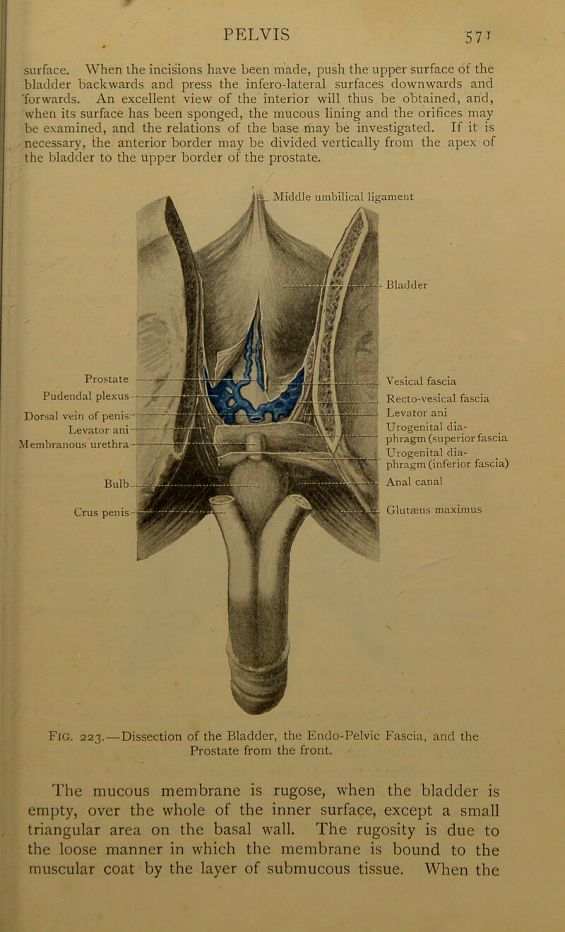 surface. When the incisions have been made, push the upper surface of the bladder backwards and press the infero-lateral surfaces downwards and 'forwards. An excellent view of the interior will thus be obtained, and, when its surface has been sponged, the mucous lining and the orifices may be examined, and the relations of the base may be investigated. If it is necessary, the anterior border may be divided vertically from the apex of the bladder to the upper border of the prostate. Prostate Pudendal plexus Dorsal vein of penis Levator ani Membranous urethra - Bulb- Crus penis- Vesical fascia Recto-vesical fascia Levator ani Urogenital dia- phragm (superior fascia Urogenital dia- phragm (inferior fascia) Anal canal Glutaeus maximus Middle umbilical ligament Bladder Fig. 223.—Dissection of the Bladder, the Endo-Pelvic Fascia, and the Prostate from the front. The mucous membrane is rugose, when the bladder is empty, over the whole of the inner surface, except a small triangular area on the basal wall. The rugosity is due to the loose manner in which the membrane is bound to the muscular coat by the layer of submucous tissue. When the