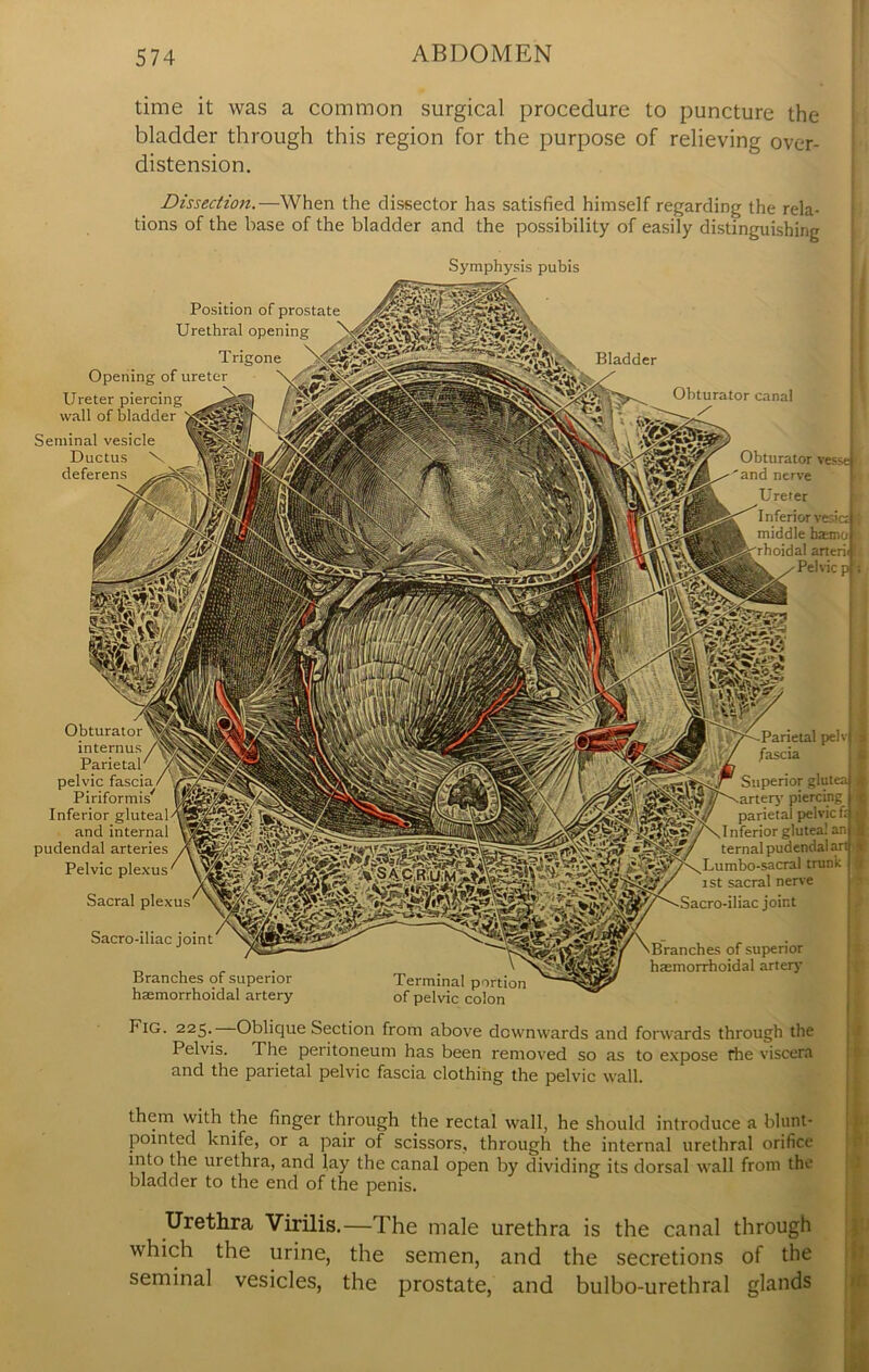 time it was a common surgical procedure to puncture the bladder through this region for the purpose of relieving over- distension. Dissection.—When the dissector has satisfied himself regarding the rela- tions of the base of the bladder and the possibility of easily distinguishing Position Urethral Trigone Opening of ureter \/v Ureter piercing -AgO wall of bladder Seminal vesicle Ductus \ deferens M.f Parietal pelvic fascia. Piriformis/ Inferior gluteal and internal pudendal arteries Pelvic plexus Sacral plexus^N^S Sacro-iliac joint Branches of superior haemorrhoidal artery Parietal pelvj / fascia Superior glutea artery piercing | parietal pelvic f: | Inferior glutea! an) ternal pudendal art JfejFy \ L u m bo - sa era 1 trunk jst sacra, nerye Sacro-iliac joint Terminal portion of pelvic colon Branches of superior haemorrhoidal artery Fig. 225. Oblique Section from above downwards and forwards through the Pelvis. The peritoneum has been removed so as to expose rite viscera and the parietal pelvic fascia clothing the pelvic wall. them with the finger through the rectal wall, he should introduce a blunt- pointed knife, or a pair of scissors, through the internal urethral orifice into the uiethra, and lay the canal open by dividing its dorsal wall from the bladder to the end of the penis. Urethra Virilis.—The male urethra is the canal through which the urine, the semen, and the secretions of the seminal vesicles, the prostate, and bulbo-urethral glands