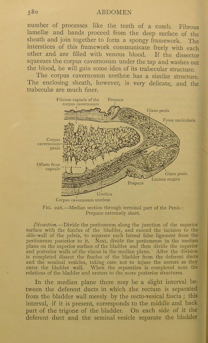 number of processes like the teeth of a comb. Fibrous lamellae and bands proceed from the deep surface of the sheath and join together to form a spongy framework. The interstices of this framework communicate freely with each other and are filled with venous blood. If the dissector squeezes the corpus cavernosum under the tap and washes out the blood, he will gain some idea of its trabecular structure. The corpus cavernosum urethrae has a similar structure. The enclosing sheath, however, is very delicate, and the trabeculae are much finer. Corpus cavernosum penis Gians penis Fossa navicularis / Prepuce Gians penis magna Offsets from capsule Urethra Corpus cavernosum urethrae Fibrous capsule of the corpus cavernosum Preouce Fig. 228.—Median section through terminal part of the Penis : Prepuce extremely short. Dissection.—Divide the peritoneum along the junction of the superior surface with the fundus of the bladder, and extend the incision to the side-wall of the pelvis, to separate each lateral false ligament from the peritoneum posterior to it. Next, divide the peritoneum in the median plane on the superior surface of the bladder and then divide the superior and posterior walls of the viscus in the median plane. After the division is completed dissect the fundus of the bladder from the deferent ducts and the seminal vesicles, taking care not to injure the ureters as they enter the bladder wall. When the separation is completed note the relations of the bladder and ureters to the more posterior structures. In the median plane there may be a slight interval be- tween the deferent ducts in which the rectum is separated from the bladder wall merely by the recto-vesical fascia ; this interval, if it is present, corresponds to the middle and back part of the trigone of the bladder. On each side of it the deferent duct and the seminal vesicle separate the bladder