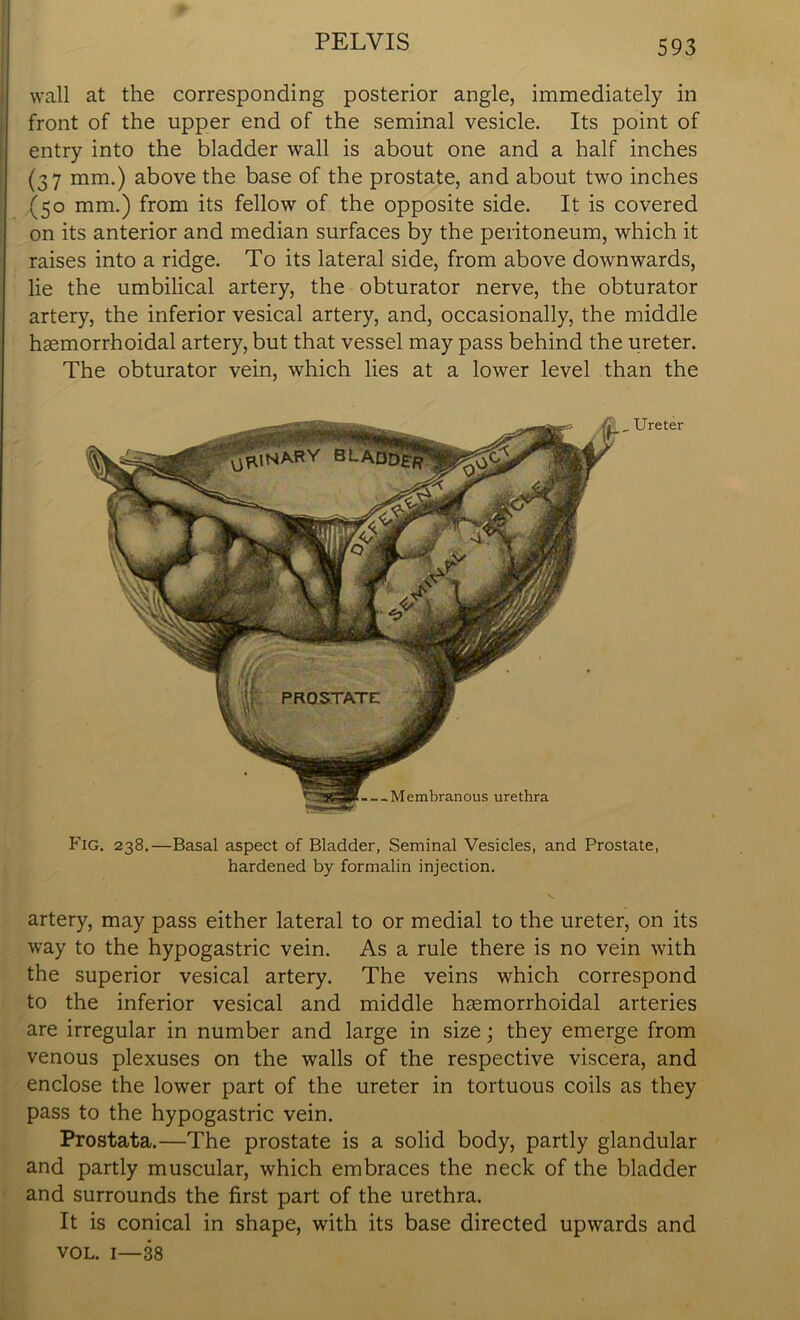 wall at the corresponding posterior angle, immediately in front of the upper end of the seminal vesicle. Its point of entry into the bladder wall is about one and a half inches (37 mm.) above the base of the prostate, and about two inches (50 mm.) from its fellow of the opposite side. It is covered on its anterior and median surfaces by the peritoneum, which it raises into a ridge. To its lateral side, from above downwards, lie the umbilical artery, the obturator nerve, the obturator artery, the inferior vesical artery, and, occasionally, the middle hcemorrhoidal artery, but that vessel may pass behind the ureter. The obturator vein, which lies at a lower level than the „ Ureter Fig. 238.—Basal aspect of Bladder, Seminal Vesicles, and Prostate, hardened by formalin injection. artery, may pass either lateral to or medial to the ureter, on its way to the hypogastric vein. As a rule there is no vein with the superior vesical artery. The veins which correspond to the inferior vesical and middle hsemorrhoidal arteries are irregular in number and large in size; they emerge from venous plexuses on the walls of the respective viscera, and enclose the lower part of the ureter in tortuous coils as they pass to the hypogastric vein. Prostata.—The prostate is a solid body, partly glandular and partly muscular, which embraces the neck of the bladder and surrounds the first part of the urethra. It is conical in shape, with its base directed upwards and vol. 1—38