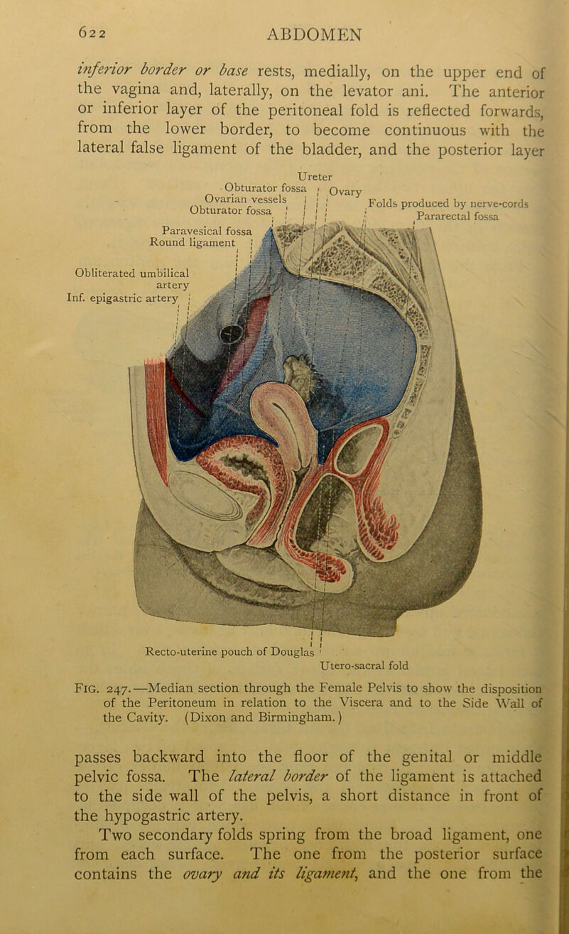 inferior border or base rests, medially, on the upper end of the vagina and, laterally, on the levator ani. The anterior or inferior layer of the peritoneal fold is reflected forwards, from the lower border, to become continuous with the lateral false ligament of the bladder, and the posterior layer Ureter Obturator fossa > Ovary Ovarian vessels Obturator fossa \ Folds produced by nerve-cords Pararectal fossa Paravesical fossa Round ligament Obliterated umbilical artery Inf. epigastric artery j Recto-uterine pouch of Douglas Utero-sacral fold Fig. 247.—Median section through the Female Pelvis to show the disposition of the Peritoneum in relation to the Viscera and to the Side Wall of the Cavity. (Dixon and Birmingham.) passes backward into the floor of the genital or middle pelvic fossa. The lateral border of the ligament is attached to the side wall of the pelvis, a short distance in front of the hypogastric artery. Two secondary folds spring from the broad ligament, one from each surface. The one from the posterior surface contains the ovary and its ligament, and the one from the