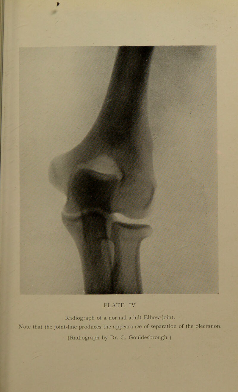 * PLATE TV Radiograph of a normal adult Elbow-joint. Note that the joint-line produces the appearance of separation of the olecranon.