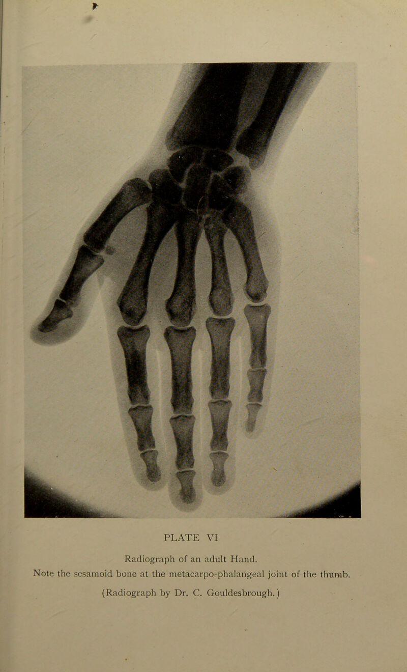 Radiograph of an adult Hand. Note the sesamoid bone at the metacarpo-phalangeal joint of the thumb.