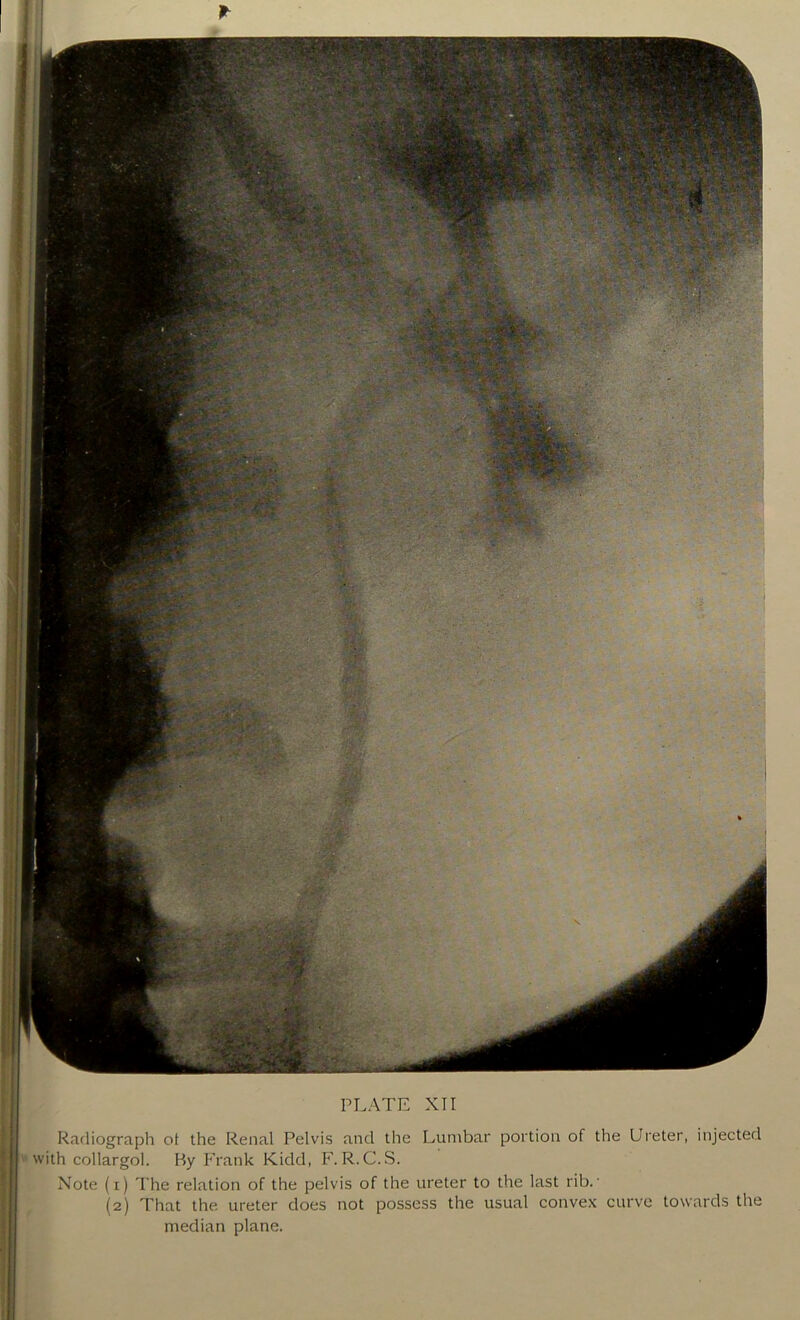 Radiograph ot the Renal Pelvis and the Lumbar portion of the Ureter, injected with collargol. By Frank Kidd, F. R.C.S. Note (i) The relation of the pelvis of the ureter to the last rib.' (2) That the ureter does not possess the usual convex curve towards the median plane.