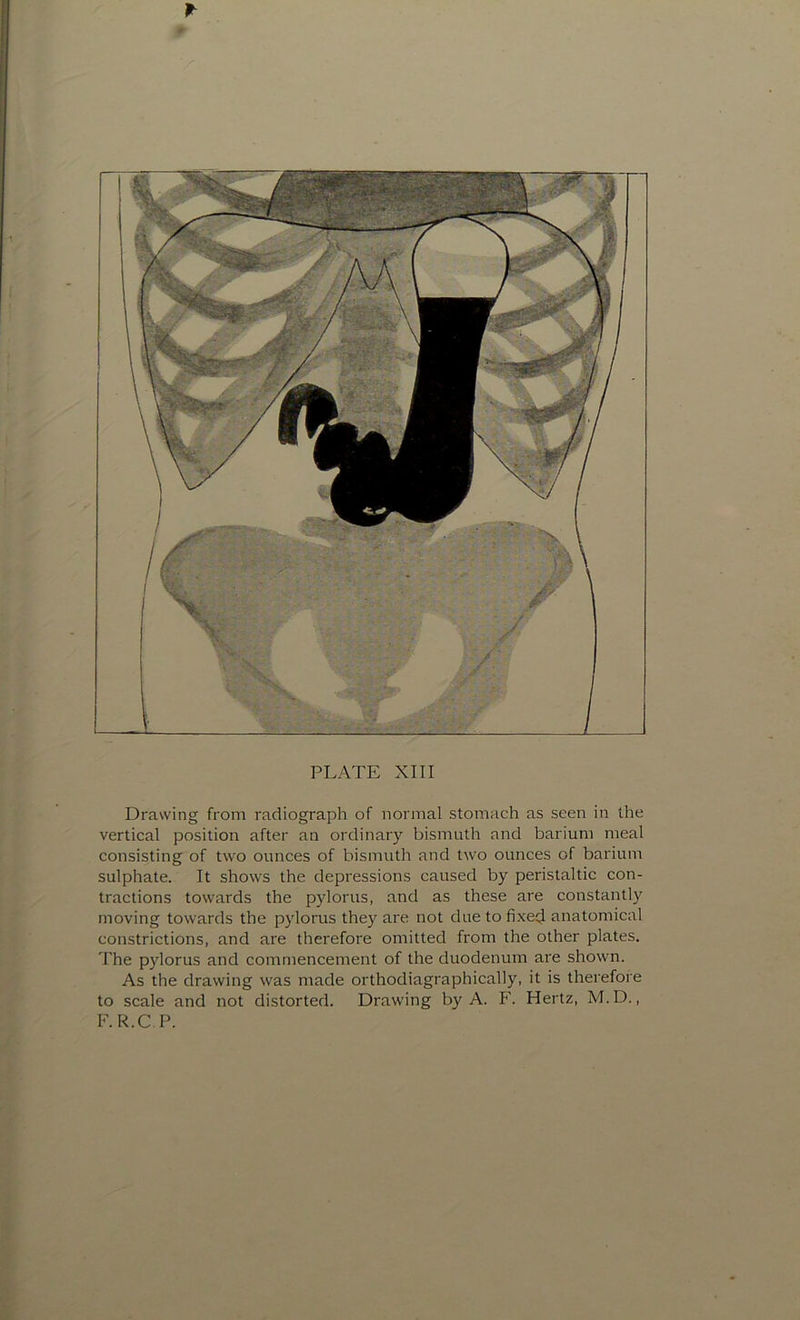 Drawing from radiograph of normal stomach as seen in the vertical position after an ordinary bismuth and barium meal consisting of two ounces of bismuth and two ounces of barium sulphate. It shows the depressions caused by peristaltic con- tractions towards the pylorus, and as these are constantly moving towards the pylorus they are not due to fixed anatomical constrictions, and are therefore omitted from the other plates. The pylorus and commencement of the duodenum are shown. As the drawing was made orthodiagraphically, it is therefore to scale and not distorted. Drawing by A. F. Hertz, M.D., F.R.CP.