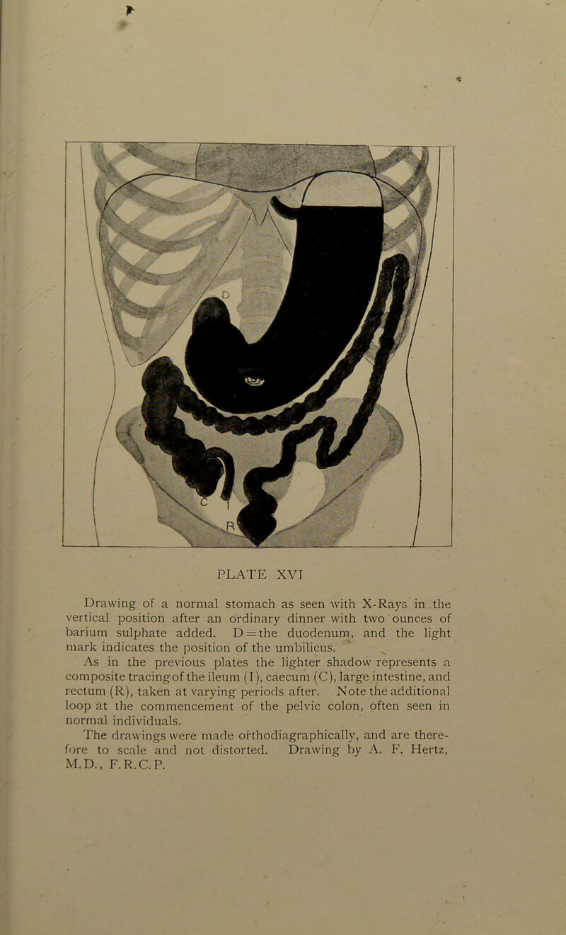 Drawing of a normal stomach as seen with X-Rays in the vertical position after an ordinary dinner with two ounces of barium sulphate added. D = the duodenum, and the light mark indicates the position of the umbilicus. As in the previous plates the lighter shadow represents a composite tracingof the ileum (I), caecum (C), large intestine, and rectum (R), taken at varying periods after. Note the additional loop at the commencement of the pelvic colon, often seen in normal individuals. The drawings were made orthodiagraphically, and are there- fore to scale and not distorted. Drawing by A. F. Hertz,