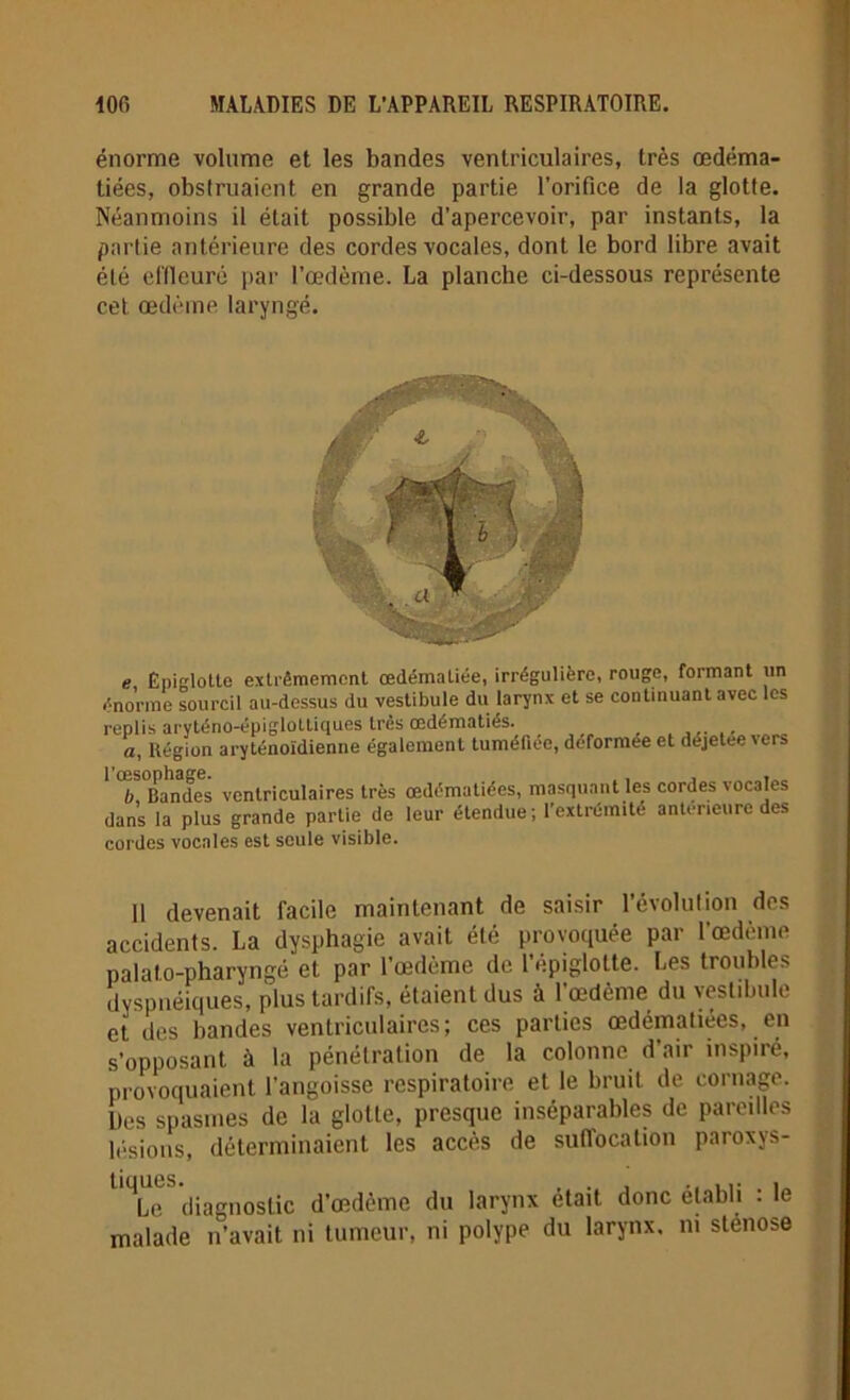 énorme volume et les bandes ventriculaires, très œdéma- tiées, obstruaient en grande partie l'orifice de la glotte. Néanmoins il était possible d’apercevoir, par instants, la partie antérieure des cordes vocales, dont le bord libre avait été effleuré par l’œdème. La planche ci-dessous représente cet œdème laryngé. e, Epiglotte extrêmement œdémaliée, irrégulière, rouge, formant un énorme sourcil au-dessus du vestibule du larynx et se continuant avec les replis aryténo-épiglottiques très œdématiés. ... a, Région aryténoïdienne également tuméfiée, déformée et dejelee vers b Bandes ventriculaires très œdématiées, masquant les cordes vocales dans la plus grande partie de leur étendue ; l’extrémité antérieure des cordes vocales est seule visible. 11 devenait facile maintenant de saisir l’évolution des accidents. La dysphagie avait été provoquée par l’œdème palato-pharyngé et par l’œdème de l’épiglolte. Les troubles dyspnéiques, plus tardifs, étaient dus à l'œdème du vestibule et des bandes ventriculaires; ces parties œdematiees, en s’opposant à la pénétration de la colonne d’air inspiré, provoquaient l'angoisse respiratoire et le bruit de cornage. Lies spasmes de la glotte, presque inséparables de pareilles lésions, déterminaient les accès de suflocation paroxys- me diagnostic d’œdème du larynx était donc établi : le malade n’avait ni tumeur, ni polype du larynx, ni stenose