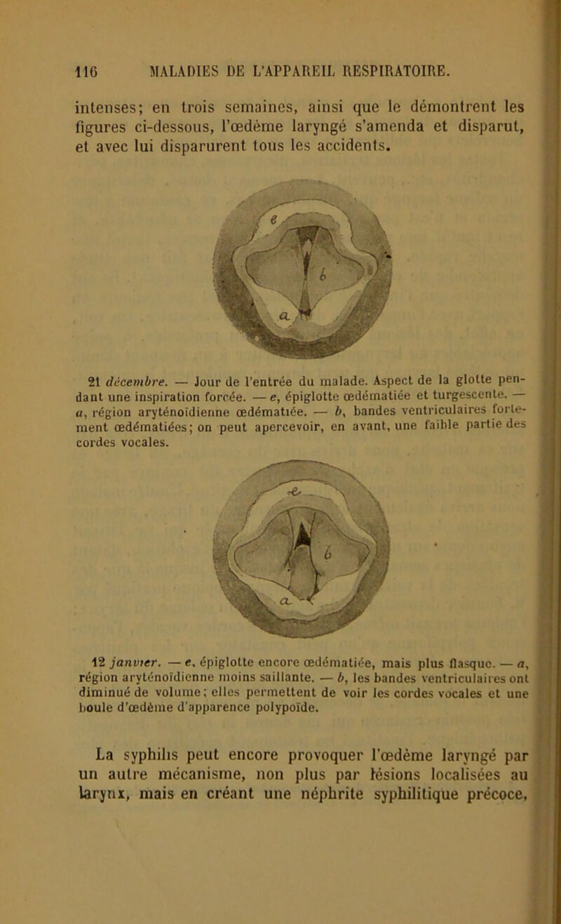 intenses; en trois semaines, ainsi que le démontrent les figures ci-dessous, l’œdème laryngé s’amenda et disparut, et avec lui disparurent tous les accidents. 21 décembre. — Jour de l’entrée du malade. Aspect de la glotte pen- dant une inspiration forcée. — e, épiglotte œdématiée et turgescente. — a, région aryténoïdierine œdématiée. — b, bandes ventriculaires forte- ment œdématiées; on peut apercevoir, en avant, une faible partie des cordes vocales. 12 janvier. —e. épiglotte encore œdématiée, mais plus flasque. — a, région aryténoîdicnne moins saillante. — b, les bandes ventriculaires ont diminué de volume; elles permettent de voir les cordes vocales et une boule d’œdème d’apparence polypoïde. La syphilis peut encore provoquer l’œdème laryngé par un autre mécanisme, non plus par lésions localisées au larynx, mais en créant une néphrite syphilitique précoce,