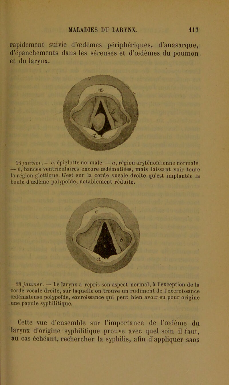 rapidement suivie d’œdèmes périphériques, d’anasarque, d’épanchements dans les séreuses et d’œdèmes du poumon et du larynx. 16janvier. — e, épiglotte normale. — a, région aryténoïdienne normale — b, bandes ventriculaires encore œdématiées, mais laissant voir toute la région glottique. C’est sur la corde vocale droite qu'est implantée la boule d'œdème polypoïde, notablement réduite. 18 janvier. — Le larynx a repris son aspect normal, à l’exception de la corde vocale droite, sur laquelle on trouve un rudiment de l’excroissance œdémateuse polypoïde, excroissance qui peut bien avoir eu pour origine une papule syphilitique. Cette vue d’ensemble sur l’importance de l’œdème du larynx d’origine syphilitique prouve avec quel soin il faut, au cas échéant, rechercher la syphilis, afin d’appliquer sans