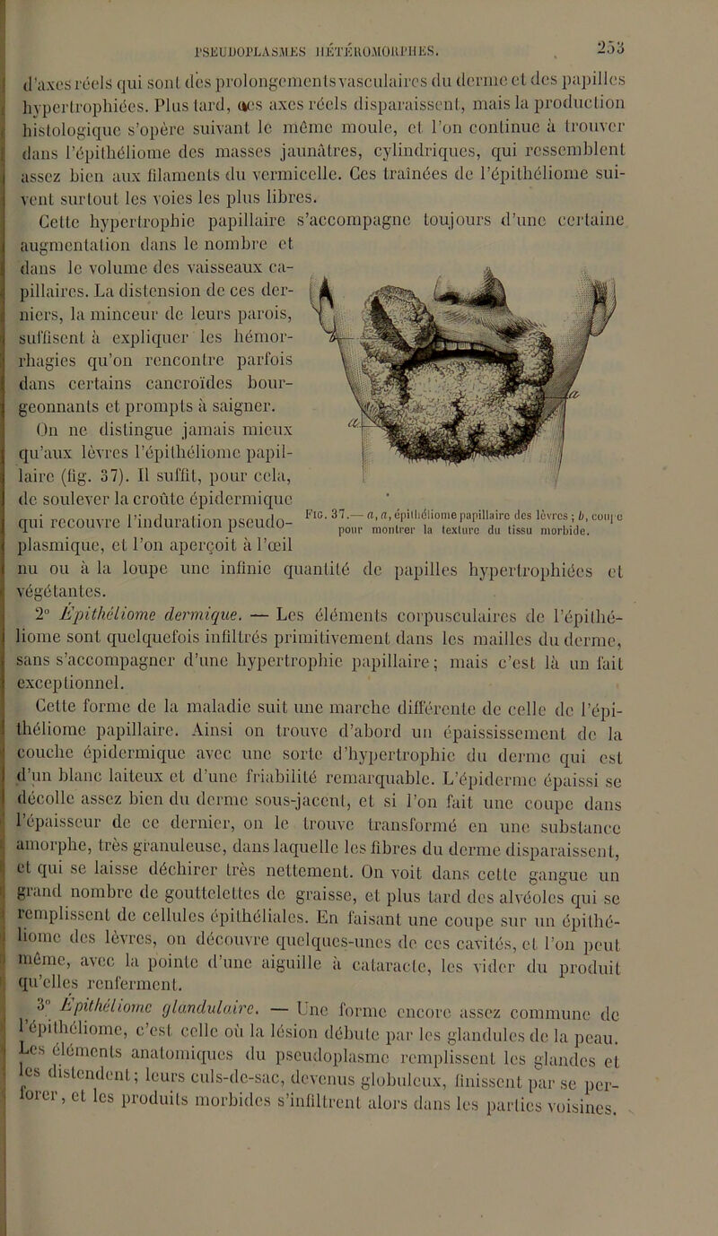 d’axes réels qui sont des prolongements vasculaires du derme et des papilles 1 hypertrophiées. Plus tard, (*cs axes réels disparaissent, mais la production histologique s’opère suivant le même moule, et l’on continue à trouver dans l’épithéliome des masses jaunâtres, cylindriques, qui ressemblent assez bien aux filaments du vermicelle. Ces traînées de l’épithéliome sui- vent surtout les voies les plus libres. Cette hypertrophie papillaire s’accompagne toujours d’une certaine augmentation dans le nombre et dans le volume des vaisseaux ca- pillaires. La distension de ces der- niers, la minceur de leurs parois, suffisent à expliquer les hémor- rhagies qu’on rencontre parfois dans certains cancroïdes bour- geonnants et prompts à saigner. On ne distingue jamais mieux qu’aux lèvres l’épithéliome papil- laire (fig. 37). Il suffit, pour cela, de soulever la croûte épidermique qui recouvre l’induration pseudo- plasmique, et l’on aperçoit à l’œil nu ou à la loupe une infinie quantité de papilles hypertrophiées et végétantes. 2° Èpithéliome dermique. — Les éléments corpusculaires de l’épi (hé- liome sont quelquefois infiltrés primitivement dans les mailles du derme, sans s’accompagner d’une hypertrophie papillaire; mais c’est là un fait exceptionnel. Cette forme de la maladie suit une marche différente de celle de l’épi- théliome papillaire. Ainsi on trouve d’abord un épaississement de la couche épidermique avec une sorte d’hypertrophie du derme qui est d’un blanc laiteux et d’une friabilité remarquable. L’épiderme épaissi se décolle assez bien du derme sous-jacent, et si l’on fait une coupe dans l’épaisseur de ce dernier, on le trouve transformé en une substance Fig. 37.— a, a, épillidliome papillaire des lèvres ; 0, coupe pour montrer la texture du tissu morbide. amorphe, très granuleuse, dans laquelle les fibres du derme disparaissent, et qui se laisse déchirer très nettement. On voit dans cette gangue un grand nombre de gouttelettes de graisse, et plus tard des alvéoles qui se remplissent de cellules épitheliales. En faisant une coupe sur un épithé- liomc des lèvres, on découvre quelques-unes de ces cavités, et l’on peut i même, avec la pointe d’une aiguille à cataracte, les vider du produit qu’elles renferment. o hpitkdiornc fjlanduluirc. — Une forme encore assez commune de épithéliome, c’est celle où la lésion débute par les glandules de la peau, es éléments anatomiques du pseudoplasme remplissent les glandes et les distendent; leurs culs-de-sac, devenus globuleux, finissent par se per- lorer, et les produits morbides s’infiltrent alors dans les parties voisines.