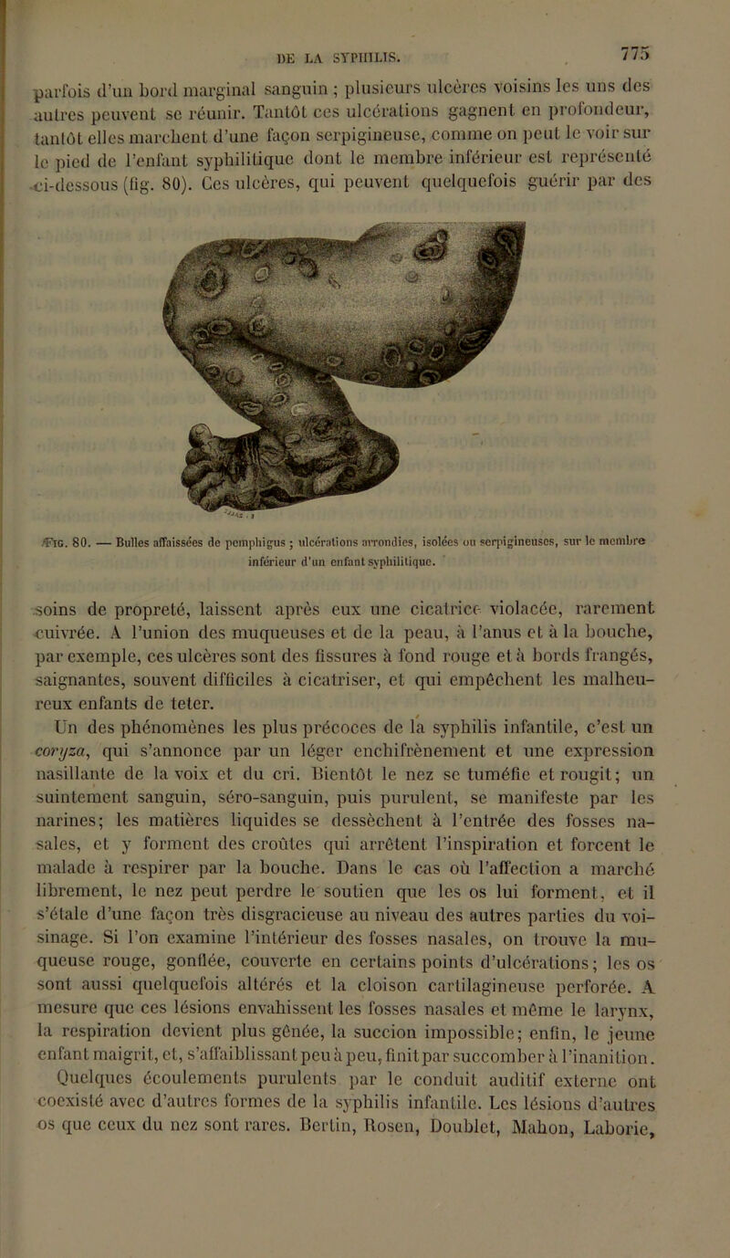 parfois d’un bord marginal sanguin ; plusieurs ulcères voisins les uns des autres peuvent se réunir. Tantôt ces ulcérations gagnent en profondeur, tantôt elles marchent d’une façon serpigineuse, comme on peut le voir sur le pied de l’enfant syphilitique dont le membre inférieur est représenté -ci-dessous (fig. 80). Ces ulcères, qui peuvent quelquefois guérir par des ., .'Fig. 80. — Bulles affaissées de pcmphigus ; ulcérations arrondies, isolées ou serpigineusos, sur le membre inférieur d’un enfant syphilitique. soins de propreté, laissent après eux une cicatrice violacée, rarement •cuivrée. A l’union des muqueuses et de la peau, à l’anus et à la bouche, par exemple, ces ulcères sont des tissures à fond rouge et à bords frangés, saignantes, souvent difficiles à cicatriser, et qui empêchent les malheu- reux enfants de teter. / Un des phénomènes les plus précoces de la syphilis infantile, c’est un coryza, qui s’annonce par un léger enchifrènement et une expression nasillante de la voix et du cri. Bientôt le nez se tuméfie et rougit; un suintement sanguin, séro-sanguin, puis purulent, se manifeste par les narines; les matières liquides se dessèchent à l’entrée des fosses na- sales, et y forment des croûtes qui arrêtent l’inspiration et forcent le malade à respirer par la bouche. Dans le cas où l’affection a marché librement, le nez peut perdre le soutien que les os lui forment, et il s’étale d’une façon très disgracieuse au niveau des autres parties du voi- sinage. Si l’on examine l’intérieur des fosses nasales, on trouve la mu- queuse rouge, gonllée, couverte en certains points d’ulcérations; les os sont aussi quelquefois altérés et la cloison cartilagineuse perforée. A mesure que ces lésions envahissent les fosses nasales et même le larynx, la respiration devient plus gênée, la succion impossible; enfin, le jeune enfant maigrit, et, s’affaiblissant peu à peu, finit par succomber à l’inanition. Quelques écoulements purulents par le conduit auditif externe ont coexisté avec d’autres formes de la syphilis infantile. Les lésions d’autres os que ceux du nez sont rares. Berlin, Rosen, Doublet, Malion, Laborie,