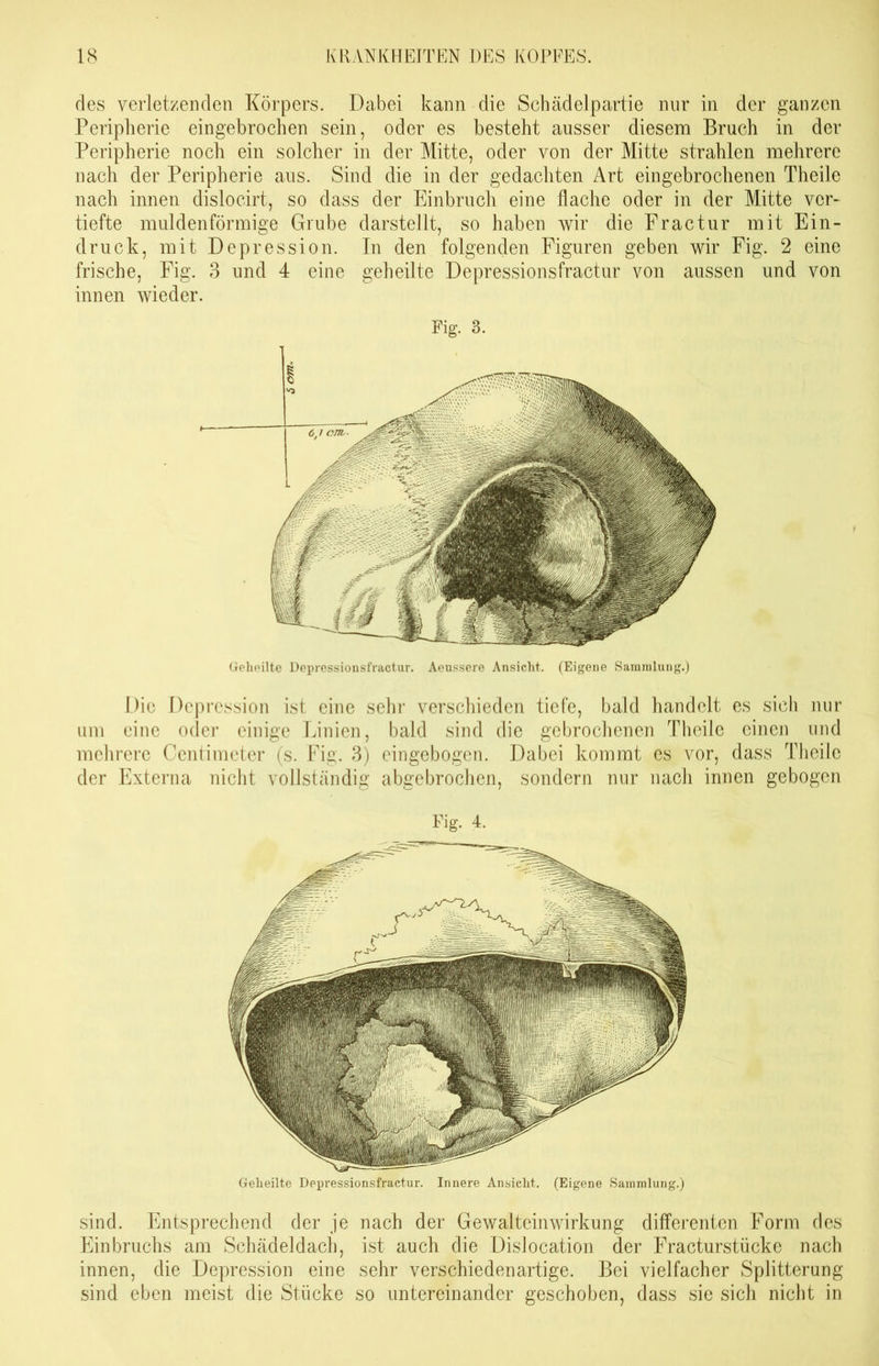 des verletzenden Körpers. Dabei kann die Schädelpartie nur in der ganzen Peripherie eingebrochen sein, oder es besteht ausser diesem Bruch in der Peripherie noch ein solcher in der Mitte, oder von der Mitte strahlen mehrere nach der Peripherie aus. Sind die in der gedachten Art eingebrochenen Theile nach innen dislocirt, so dass der Einbruch eine flache oder in der Mitte ver- tiefte muldenförmige Grube darstellt, so haben wir die Fractur mit Ein- druck, mit Depression. In den folgenden Figuren geben wir Fig. 2 eine frische, Fig. 3 und 4 eine geheilte Depressionsfractur von aussen und von innen wieder. Fig. 3. Geheilte Depressionsfractur. Aeussere Ansicht. (Eigene Sammlung.) Die Depression ist eine sehr verschieden tiefe, bald handelt es sich nur um eine oder einige Linien, bald sind die gebrochenen Theile einen und mehrere Centimeter (s. Fig. 3) eingebogen. Dabei kommt es vor, dass Theile der Externa nicht vollständig abgebrochen, sondern nur nach innen gebogen Fig. 4. Geheilte Depressionsfractur. Innere Ansicht. (Eigene Sammlung.) sind. Entsprechend der je nach der Gewalteinwirkung differenten Form des Einbruchs am Schädeldach, ist auch die Dislocation der Fracturstücke nach innen, die Depression eine sehr verschiedenartige. Bei vielfacher Splitterung sind eben meist die Stücke so untereinander geschoben, dass sie sich nicht in