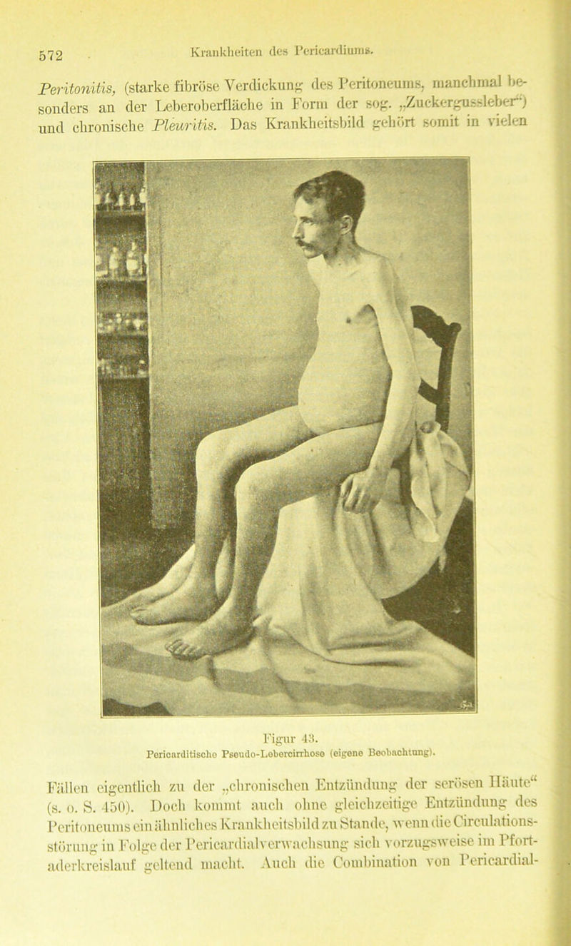 Peritonitis, (starke fibrose Verdickung des Peritoneums, manchmal be- sonders an der Leberoberflache in Form der sog. „Zuckergussleber“) und chroniscbe Pleuritis. Das Krankheitsbild gehSrt somit in vielen Figur 43. Pericarditischo Pseudo-Loborcirrhoso (eigen© Beobachtung). Fallon eigcntlieh zu der „chronischen Entziindung der serosen Haute (s. o. S. 450). Dock kommt auclv oline gleidizeitige Entziindung des Peritoneumseiniihnliches Krankheitsbild zuStande, wenndieCirculations- storung in Folge der Pericardialvenvaclisung sick vorzugsweise im Pfort- aderkreislauf gcltend mackt. Audi die Combination ion 1 ciicaidial-