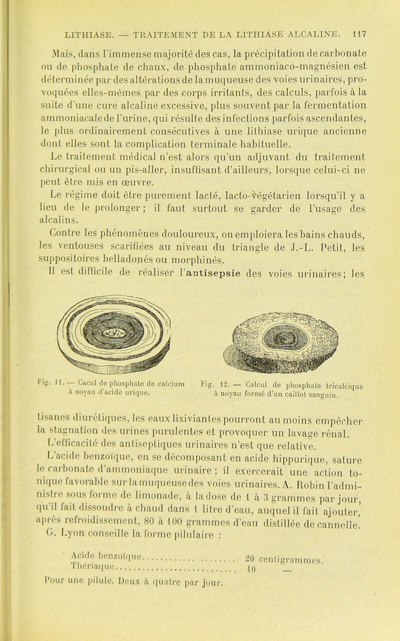 .Mais, dans l’immense majorité des cas, la précipitation de carbonate on de |)Iiosphate de chau.x, de phosphate ammoniaco-magnésien est déterminée par des altérations de la mu(iueusc des voies urinaires, pro- voquées elles-mêmes par des corps irritanls, des calculs, parfois à la suite d'une cure alcaline excessive, plus souvent par la fermentation ammoniacalede l’urine, qui résulte des infections parfois ascendantes, le plus ordinairement consécutives à une lithiase urique ancienne dont elles sont la complication terminale habituelle. Le traitement médical n’est alors qu’un adjuvant du traitement chirurgical ou un pis-aller, insuflisant d’ailleurs, lorsque celui-ci ne ])eut être mis en œuvre. Le régime doit être purement lacté, lacto-Végétarien lorsqu’il y a lieu de le prolonger; il faut surtout se garder de l’usage des alcalins. Contre les phénomènes douloureux, on emploiera les bains chauds, les ventouses scarifiées au niveau du triangle de .l.-L. Petit, les suppositoires helladonés ou morphinés. 11 est difficile de réaliser l’antisepsie des voies urinaires; les fig. 11. — Cacul (le phosphate de calcium à noyau d'acide urique. l'ig. 12. Calcul de phosphate tricalcique à noyau formé d’un caillot sanguin. tisanes diurétiques, les eaux lixiviantes pourront au moins empêcher la stagnation des urines purulentes et provoquer un lavage rénal. L’efficacité des antiseptiques urinaires n’est que relative. L’acide henzo'niue, en se décomposant en acide hippuiique, sature le carbonate d’ammoniaque urinaire; il exercerait une action to- nique favorable sur larnuqueusedes voies urinaires. A. Robin l’admi- nistre sous forme de limonade, à la dose de 1 à 3 grammes par joui, qu il fait dissoudre à chaud dans t litre d’eau, auquel il fait ajouter, apres refroidissement, 80 à 100 grammes d’eau distillée de cannelle. G. Lyon conseille la forme pilulaire : Acide benzoï(|ue Tliêria(|iie four une pilule. Deux à (piatre par jour. 20 ccnligraiiimes. ■Il) _