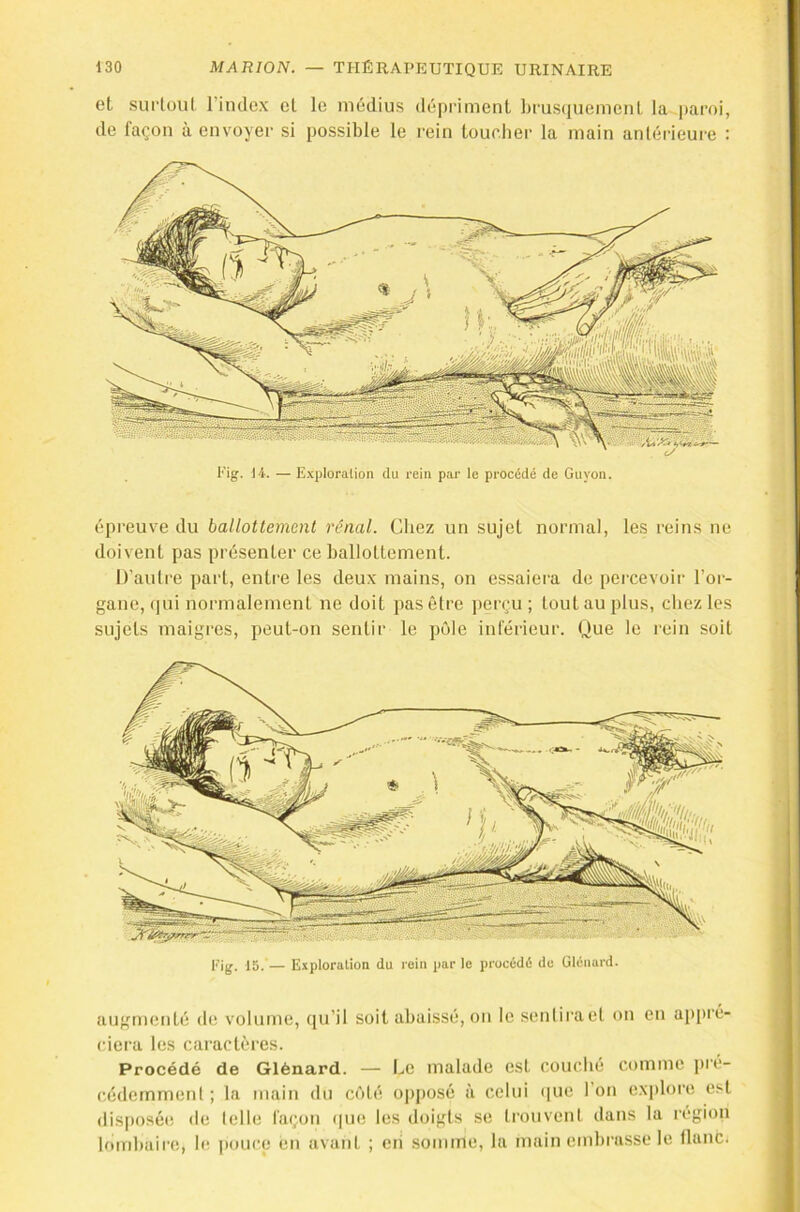 et sulioiil rindex et le médius dépriment brusquement la |)aroi, de façon à envoyer si possible le rein toucher la main antérieure : Pig. H. — Exploralion du rein par le procédé de Guyon. épreuve du ballottement rénal. Chez un sujet normal, les reins ne doivent pas présenter ce ballottement. D’auti’e part, entre tes deux mains, on essaiera de percevoir l’or- gane, (jui normalement ne doit pas être perçu ; tout au plus, chez les sujets maigres, peut-on sentir le pôle inférieur. Que le rein soit Fig. 15.— Exploration du rein par le procédé de ülénard. augmenté de volume, ([u’il soit abaissé, on le sentira et on en ap[)ré- ciera les caractères. Procédé de Glénard. — Le malade est couché comme pré- cédemment ; la main du cété opposé à celui que l’on explore est disposée de telle façon i|ue les doigts se trouvent dans la région lombaire, b; pouce en avant ; cii somme, la main embrasse le flanc.