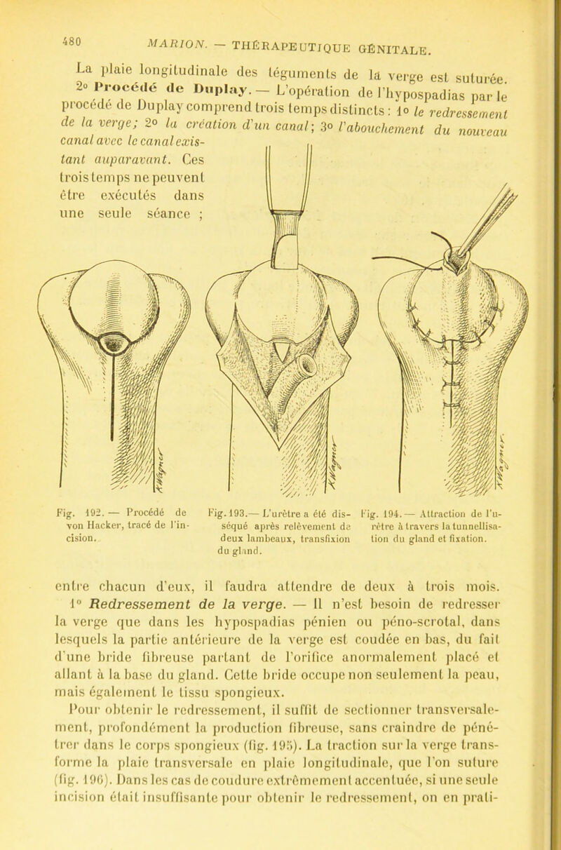 La plaie longitudinale des léginnents de la verge est suturée 2o Procédé de D,.play._ L'opération de l’hypospadias parle procédé de Duplay comprend trois temps distincts : lo le redressement de la verge; 2o la création d'un canal; 30 l'abouchement du nouveau canal avec le canal exis- tant auparavant. Ces trois temps ne peuvent être exécutés dans une seule séance ; ly Fig. 192. — Procédé de von Hacker, tracé de l'in- cision. Fig. 193.— I.’urèlre a été dis- séqué après relèvement de deux lambeaux, transfixion du gland. Fig. 194.— .-Utraction de l’u- rètre à travers latunnellisa- lion du gland et fixation. entre chacun d’eux, il faudra attendre de deux à trois mois. 1® Redressement de la verge. — 11 n’est besoin de redresser la verge que dans les hypospadias pénien ou péno-scrotal, dans lesquels la partie antérieure de la verge est coudée en bas, du fait d'une bride fibreuse partant de l’orifice anormalement placé et allant à la base du gland. Celte bride occupe non seulement la peau, mais également le tissu spongieux. Pour obtenir le redressement, il suftil de sectionner transversale- ment, profondément la production tihreuse, sans craindre de péné- trer dans le corps spongieux (tig. lOli). La traction sur la verge trans- forme la plaie transversale en [ilaie longitudinale, que l’on suture (fig. 19(j). Dans les cas de coudure extrêmement accentuée, si une seule incision était insuffisante pour obtenir le redressement, on en prati-