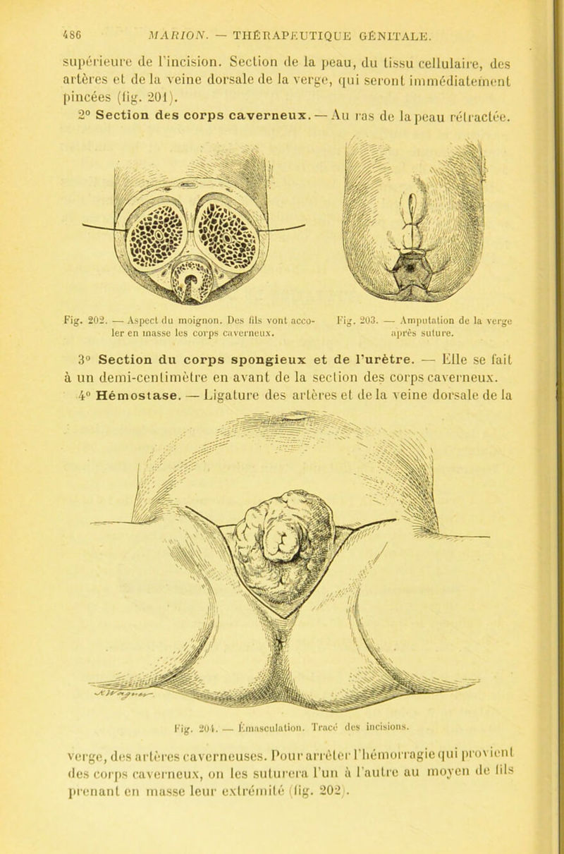suitérieuro de l’incision. Section de la peau, du tissu cellulaire, des artères et de la veine dorsale de la verge, qui seront immédiatement pincées (lig. 201). 2° Section des corps caverneux. — Au ras de la peau réli actée. Fig. 202. — Aspect du moignon. Des (ils vont acco- ler en masse les corps caverneu.x. Fig. 2ü3. — .Vmputation de la verge après suture. 3® Section du corps spongieux et de l’urètre. — Elle se fait à un demi-centimètre en avant de la section des corps caverneux. 4® Hémostase. — Ligature des artères et de la veine dorsale de la Fig. 201. Kmasculation. Tracé des incisions. verge, des artères caverneuses. Potirarrèler riiémorragie (|ui provieni des corjts caverneux, on les suturera Lun à l'autre au moyen de lits prenant en masse leur exirémilé (lig. 202).